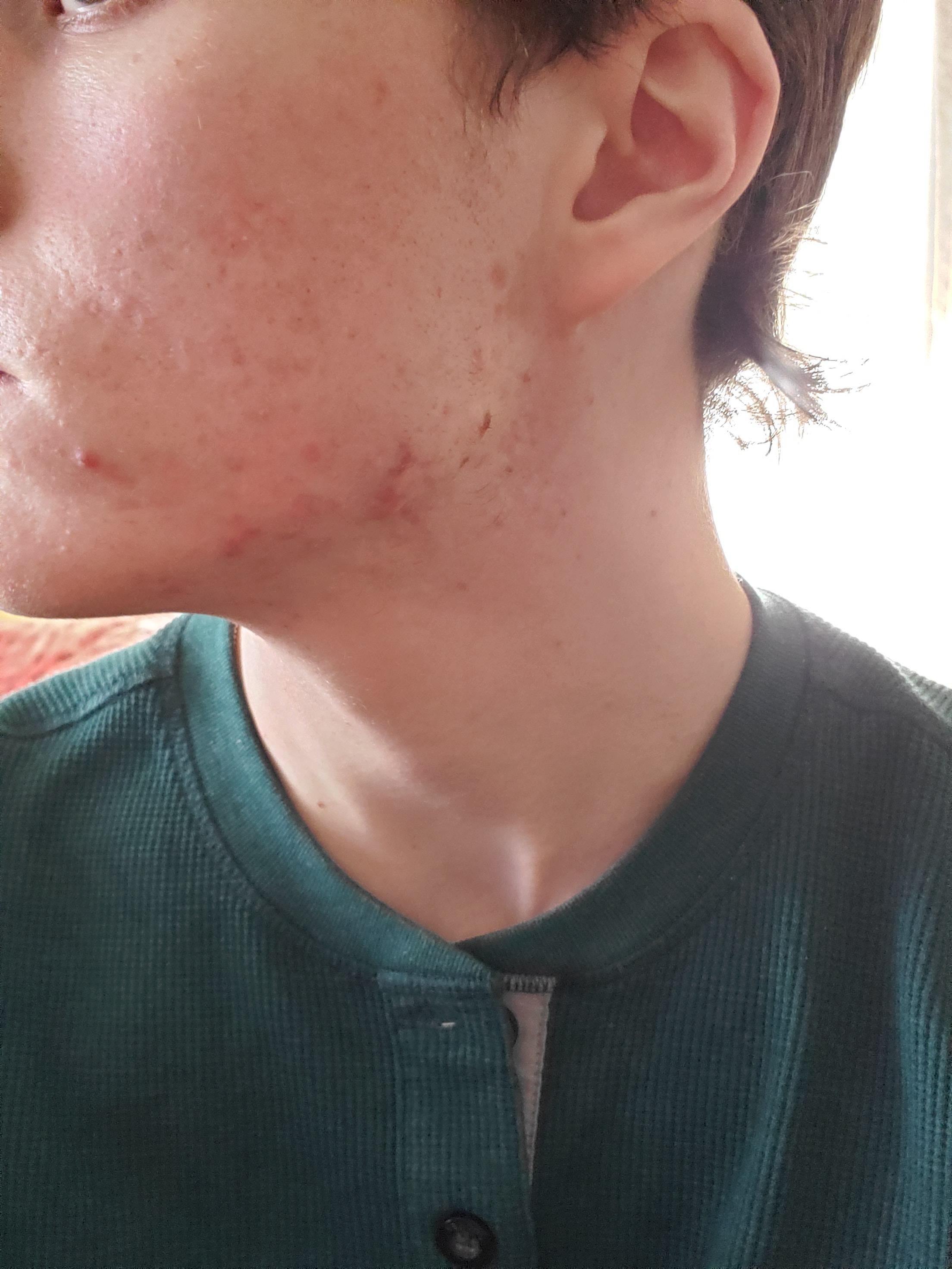 Any suggestions on jawline acne? r/acne
