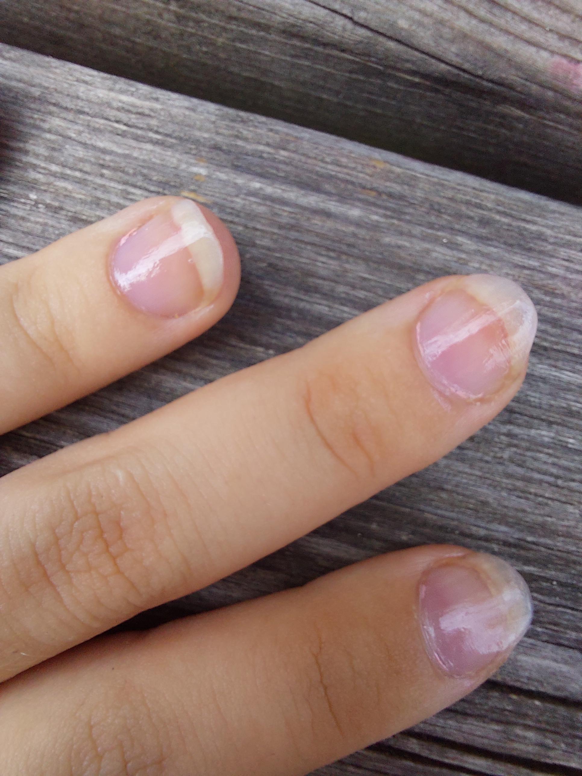 my nails are a but darker around the middle, is that normal or are they