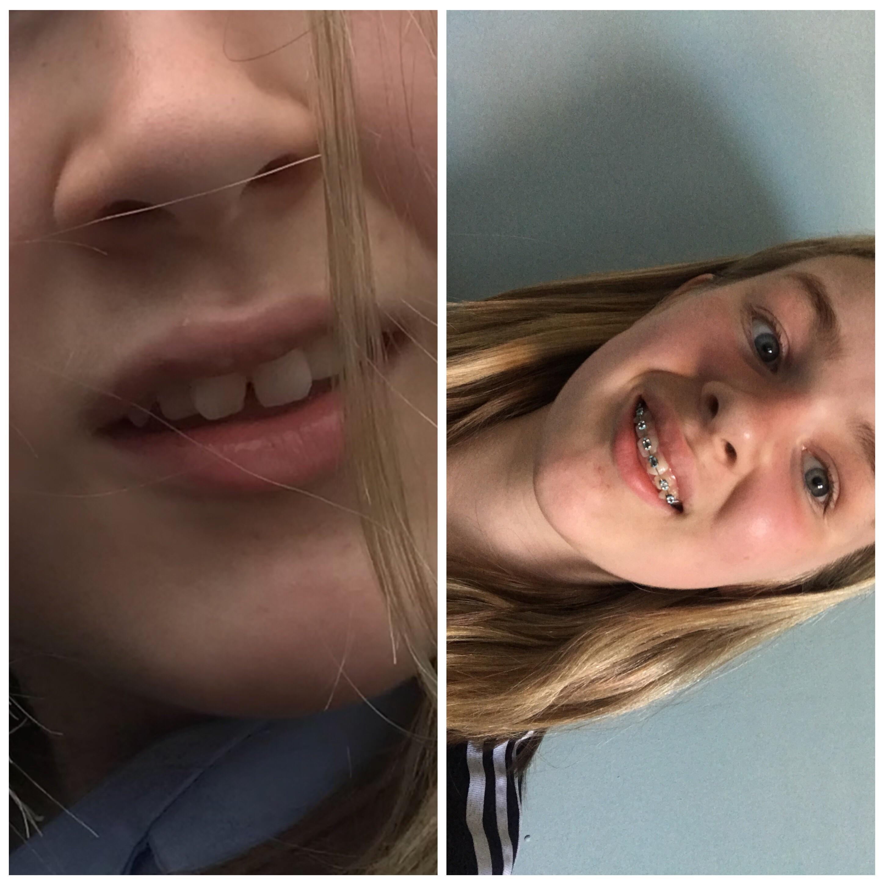 almost 1 month of braces! can’t believe how much everything’s changed