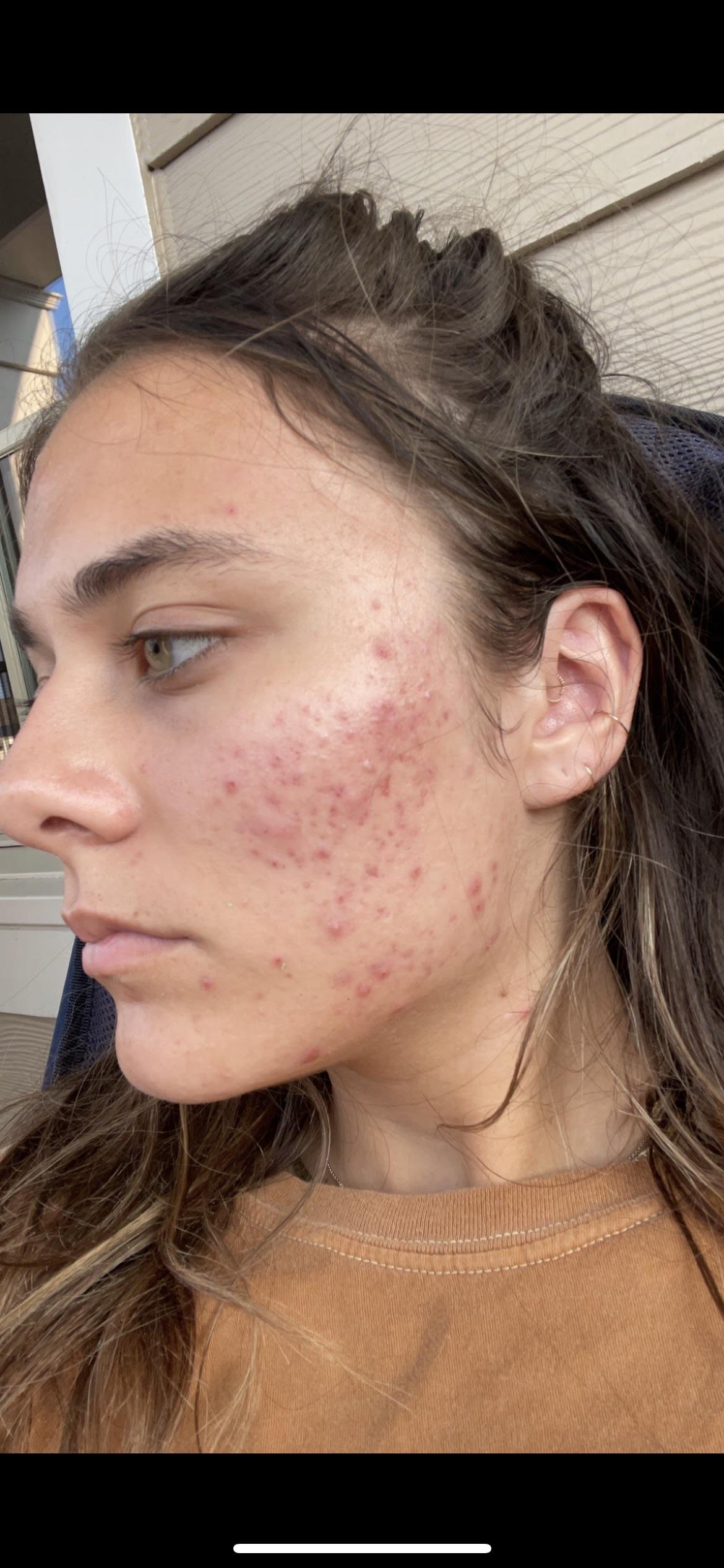 Curly hair turning straight on accutane?! Accutane