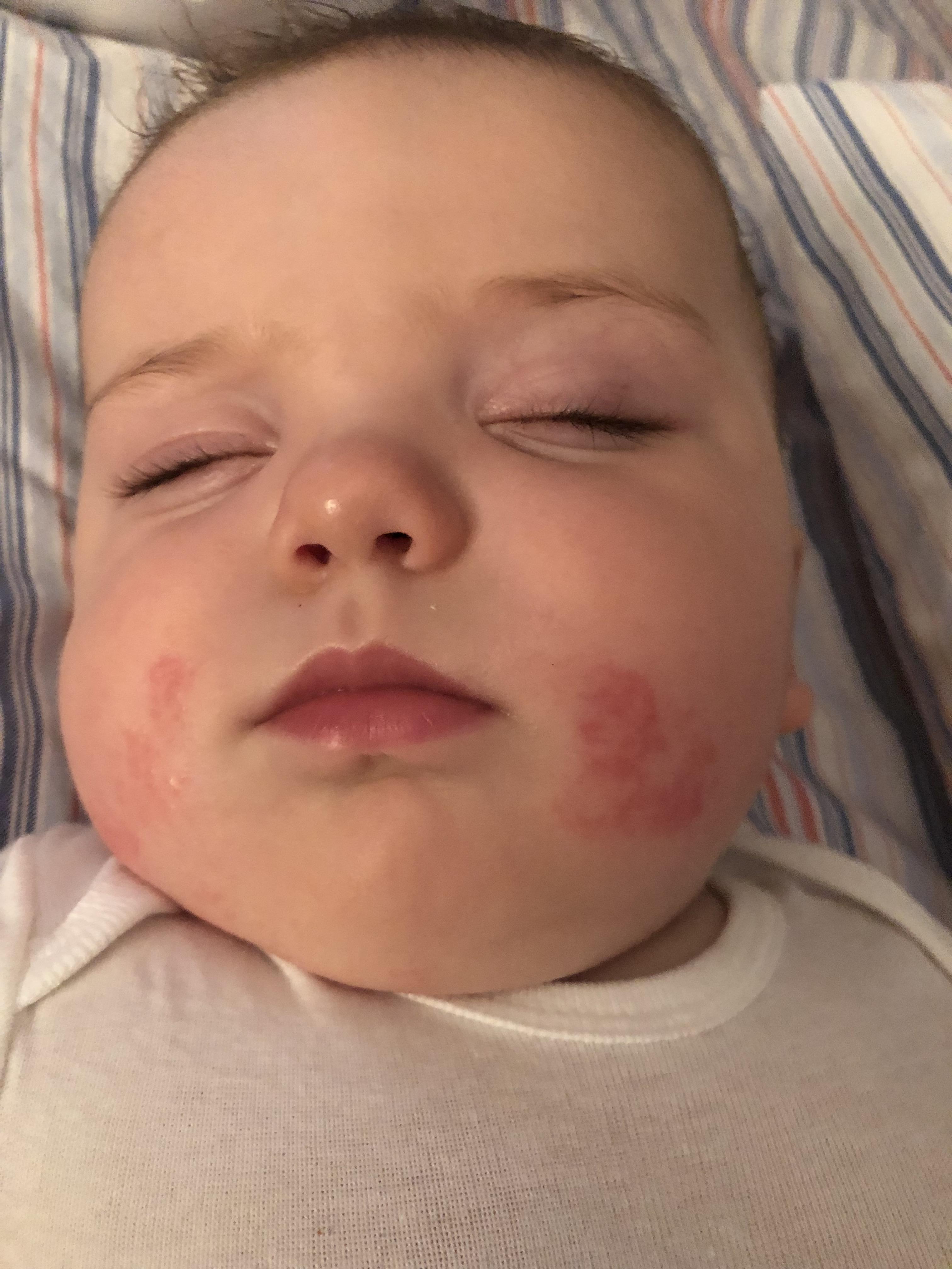 What the heck are these red splotches on my little guy’s face?!! He’s