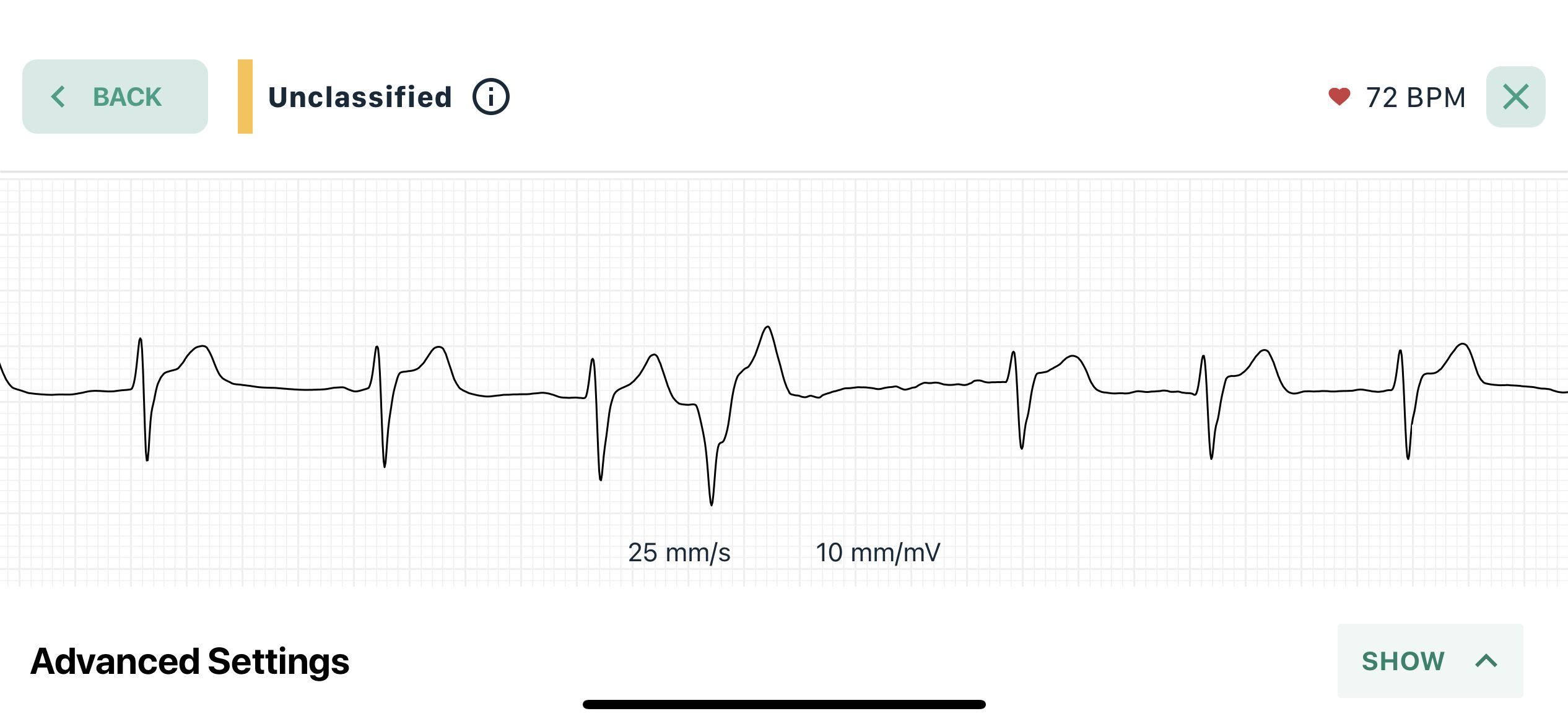 Finally caught another palpitation on ekg does this look like a pvc/pac