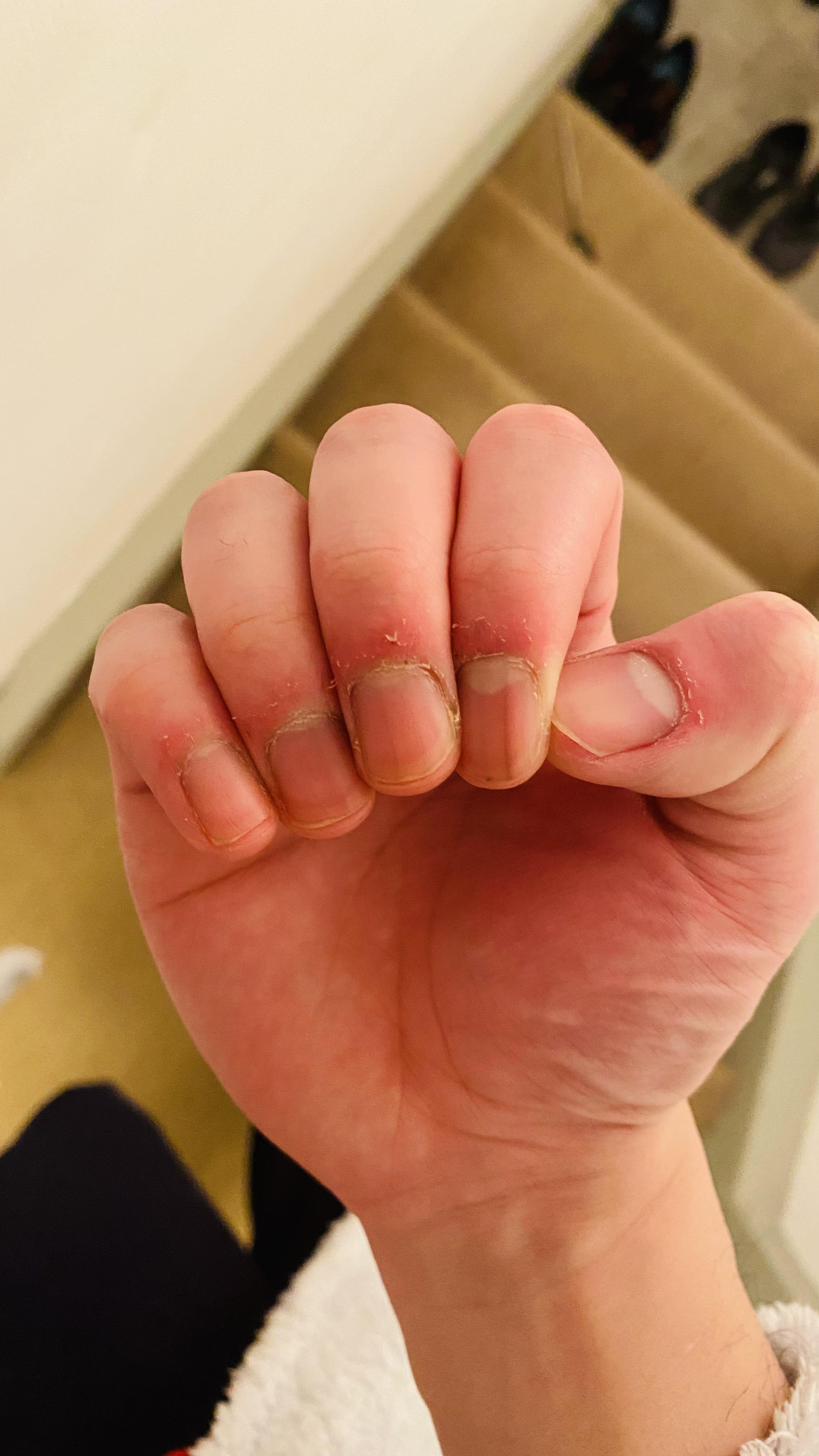 My nails fold looks terrible ! Everytime getting a dry nails fold skin