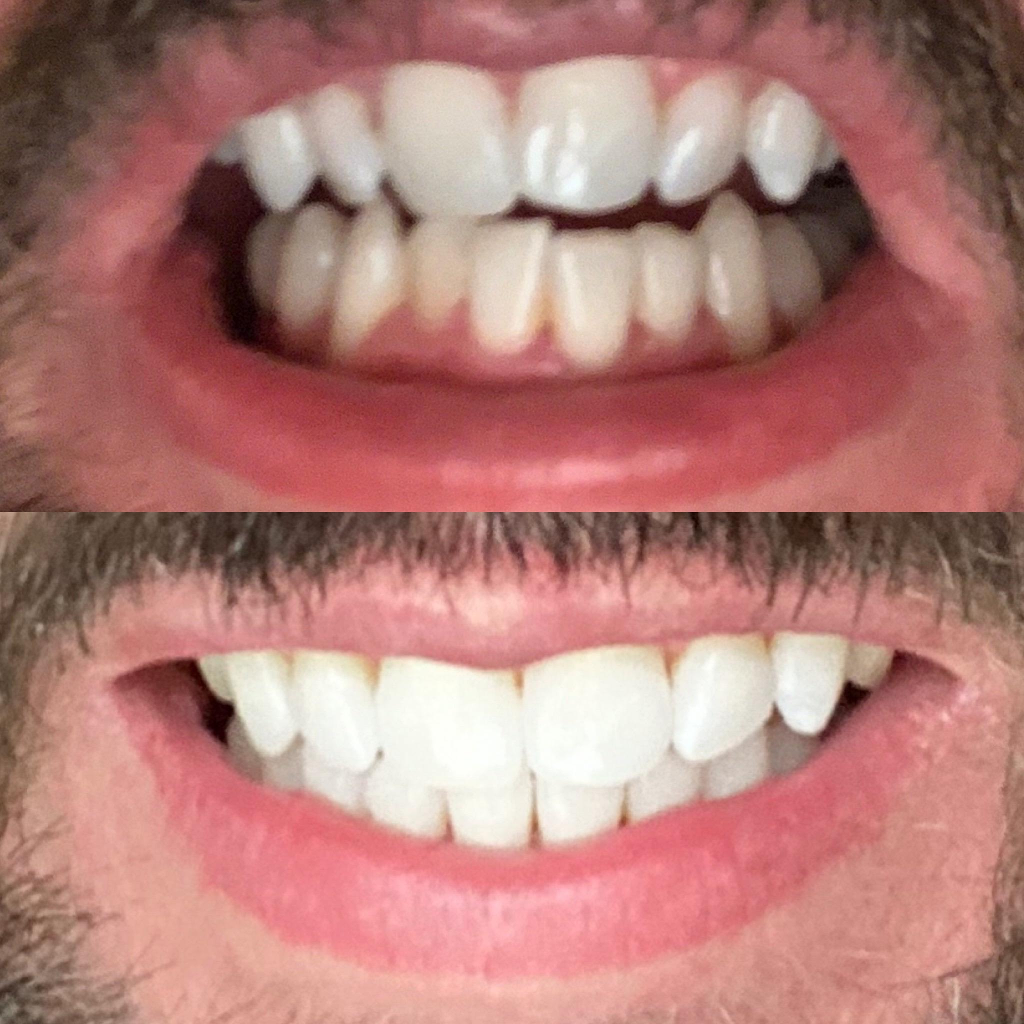 Smile direct plus zoom whitening! Very thankful for the finished