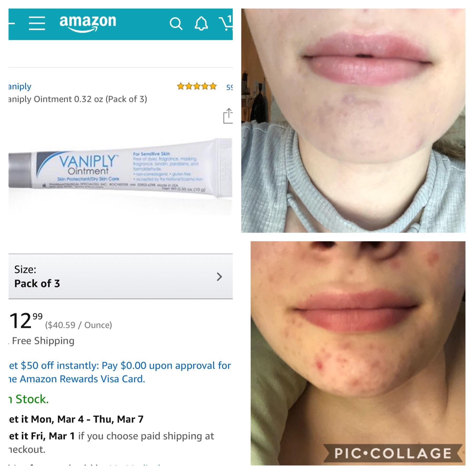 Lip Lifesaver I start accutane tomorrow but I’ve always had super