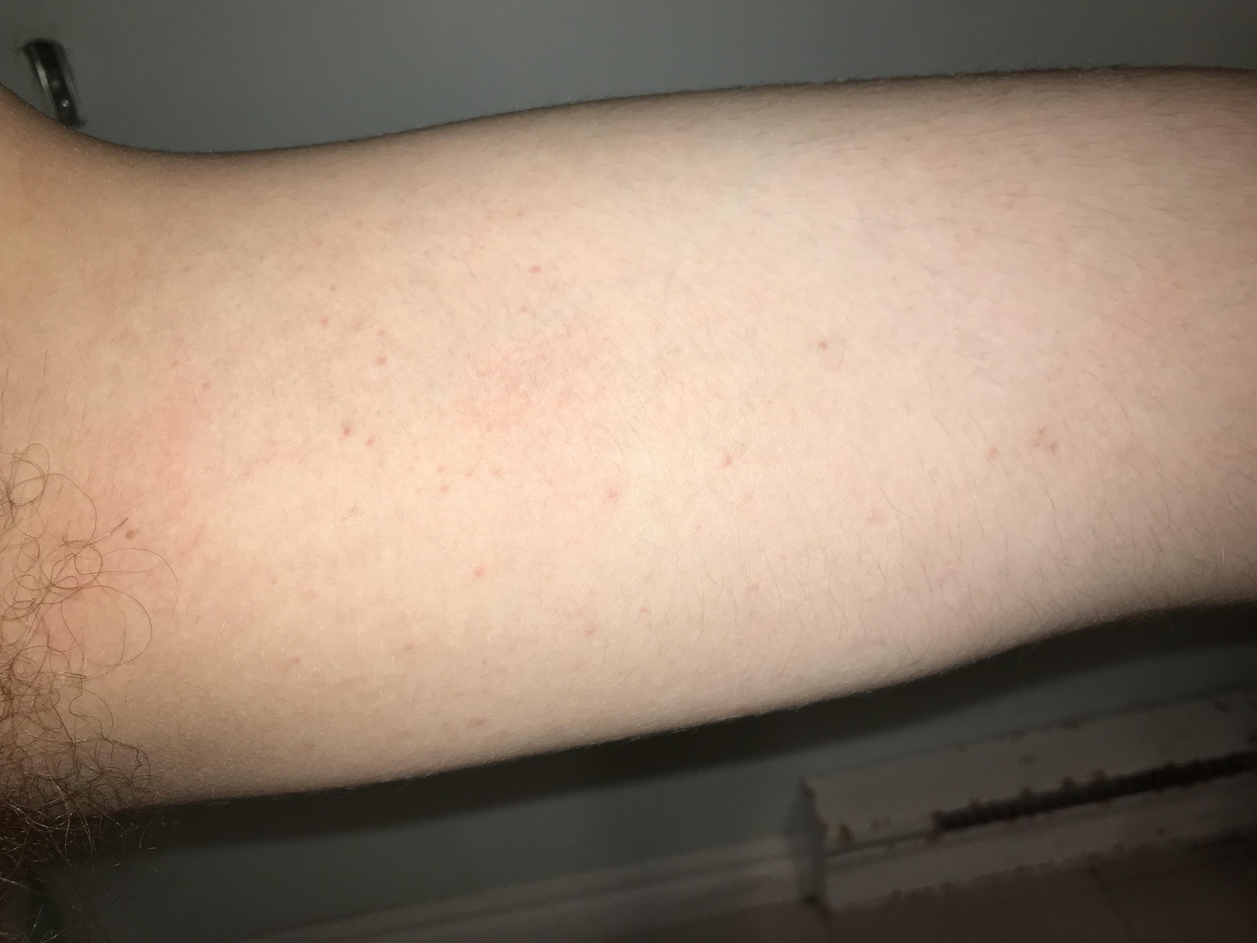 Strange rash on inner thigh doesn’t itch it just kinda showed up and it