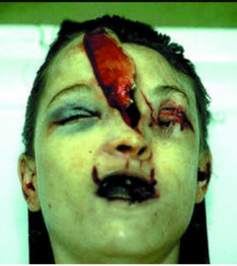 Firearm Suicide eyeblech