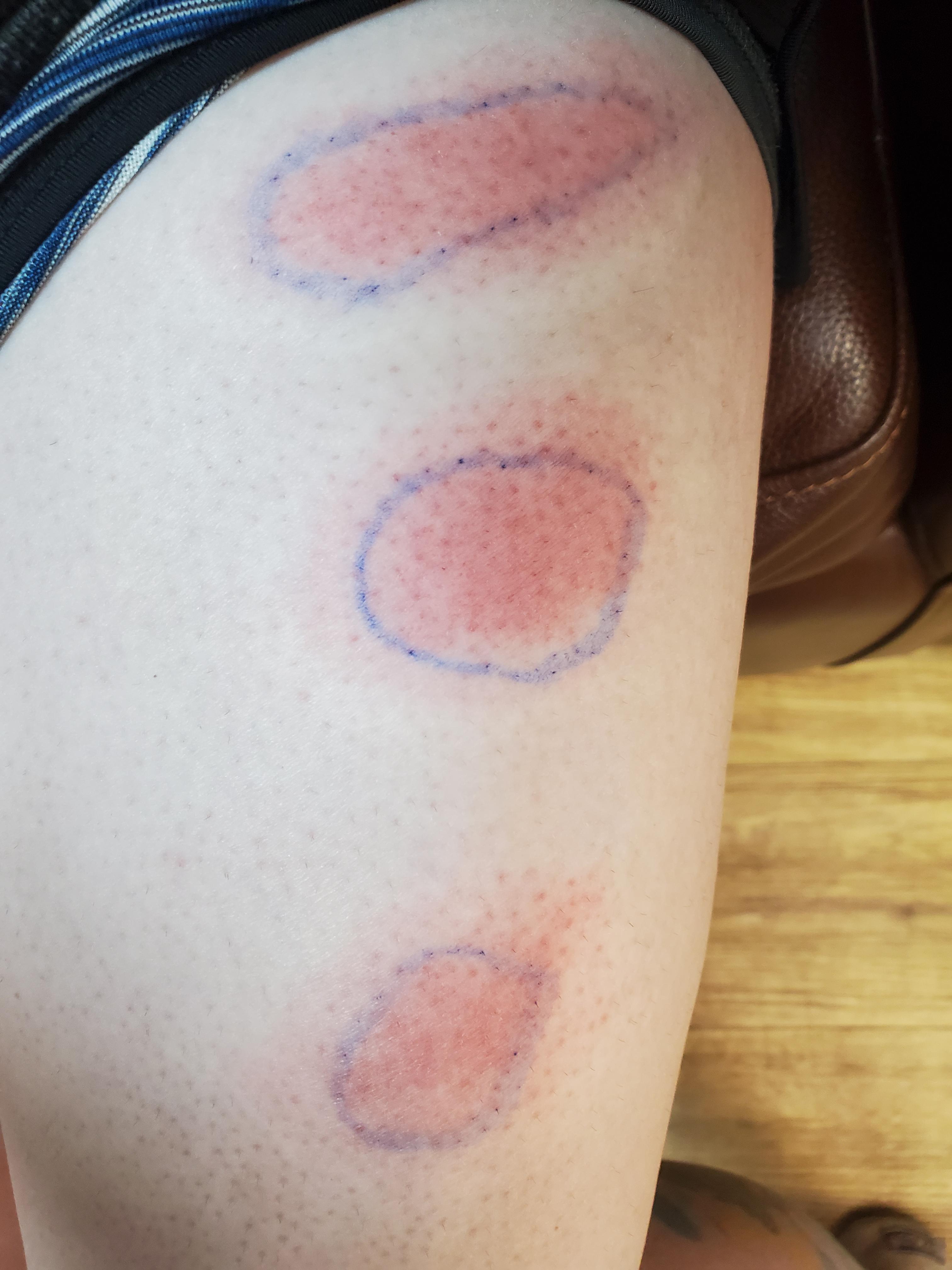 Emgality reaction (cluster headache dose) 48 hours after injections. Urgent Care says drug