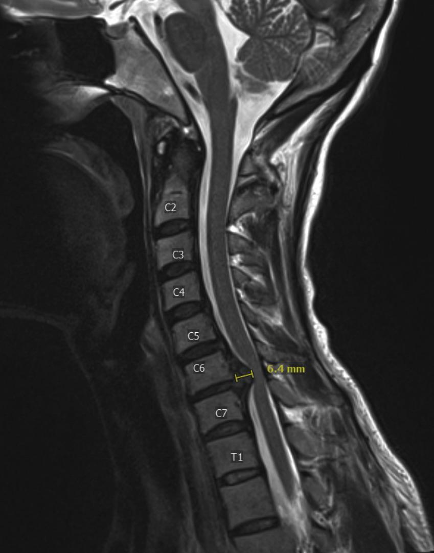 Herniated c6/c7 disc r/HerniatedDisc