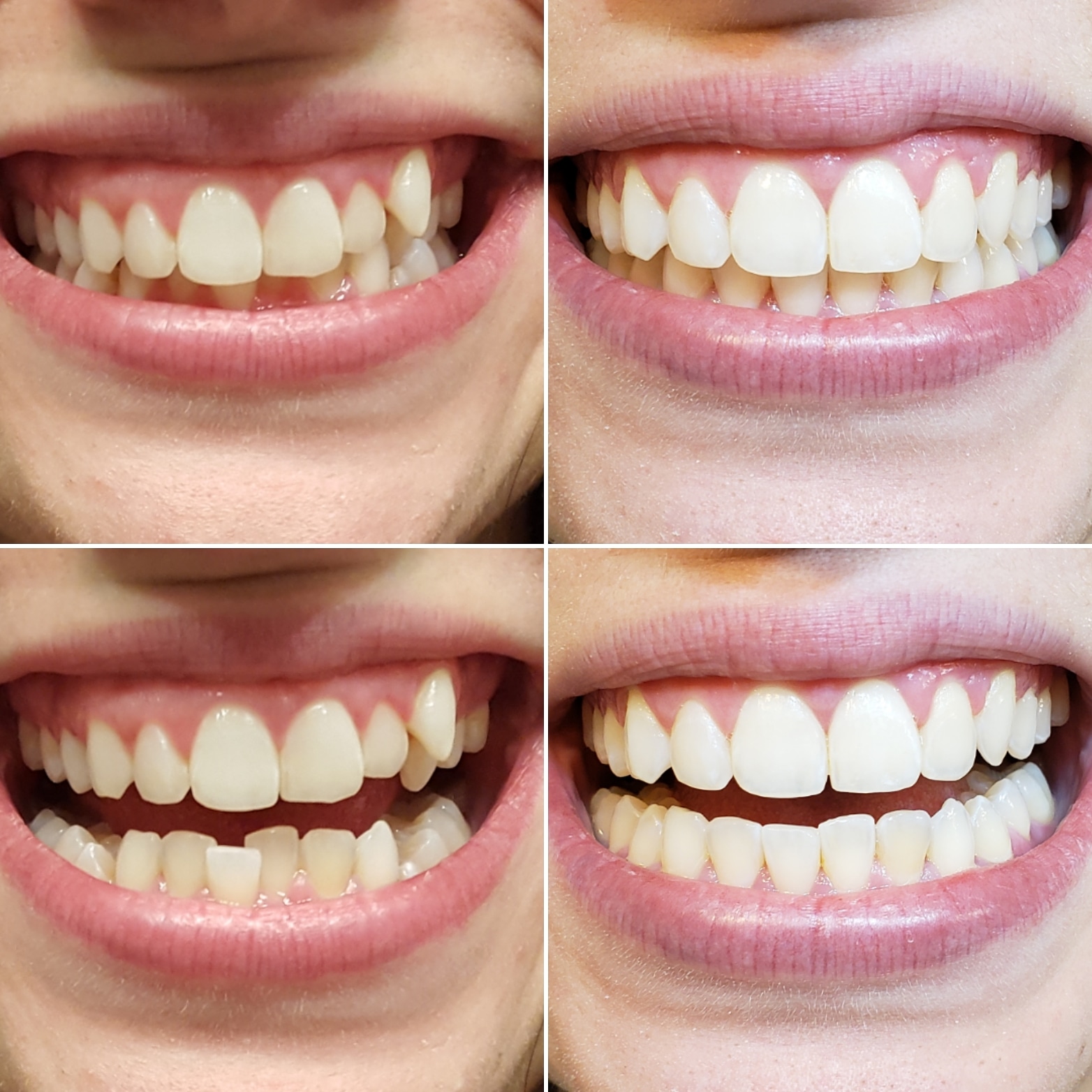 4 best u/thebeebeegun images on Pholder Invisalign, X Vcrosstrek and