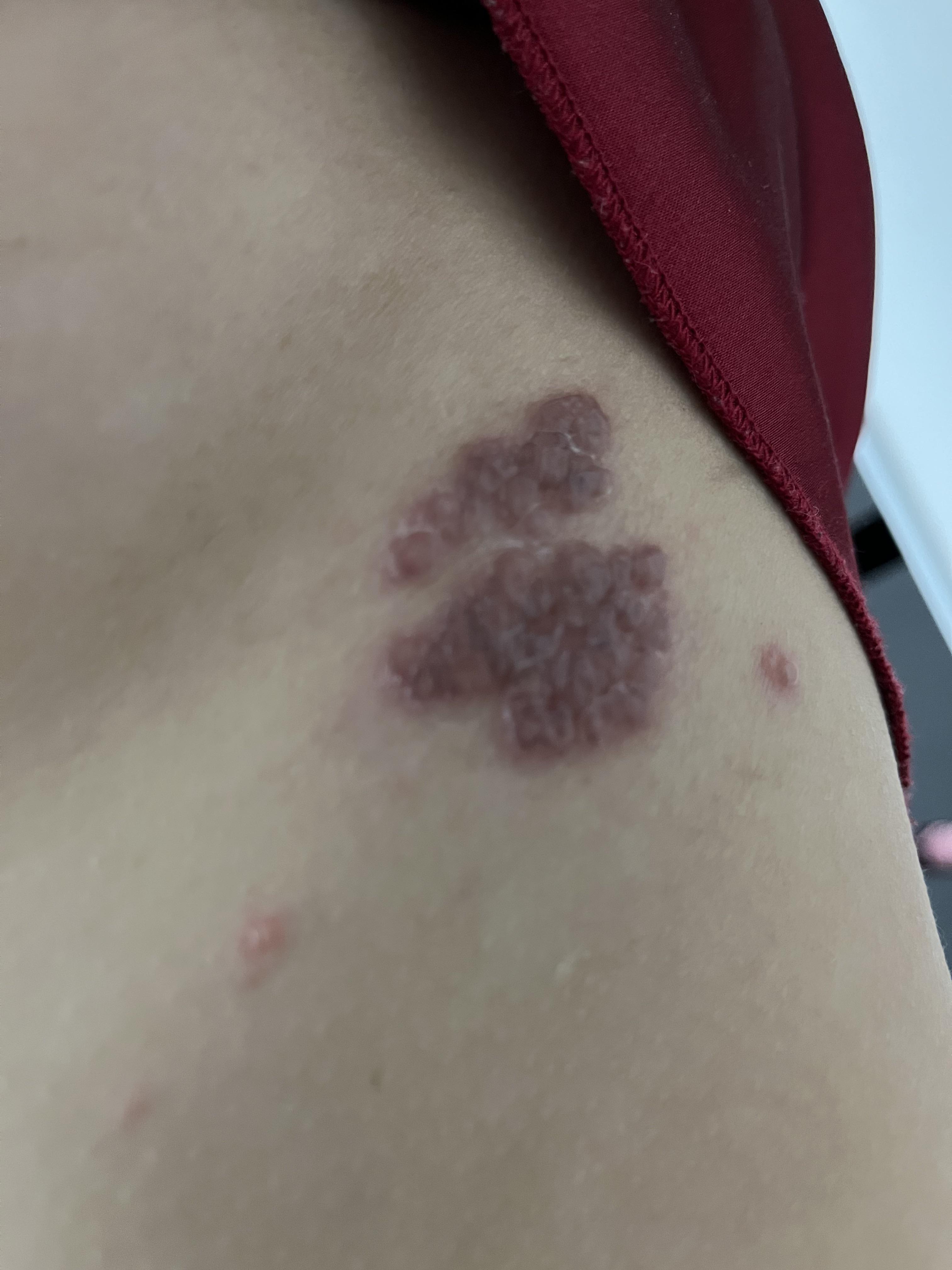 When will the blisters shrink or go away? r/shingles