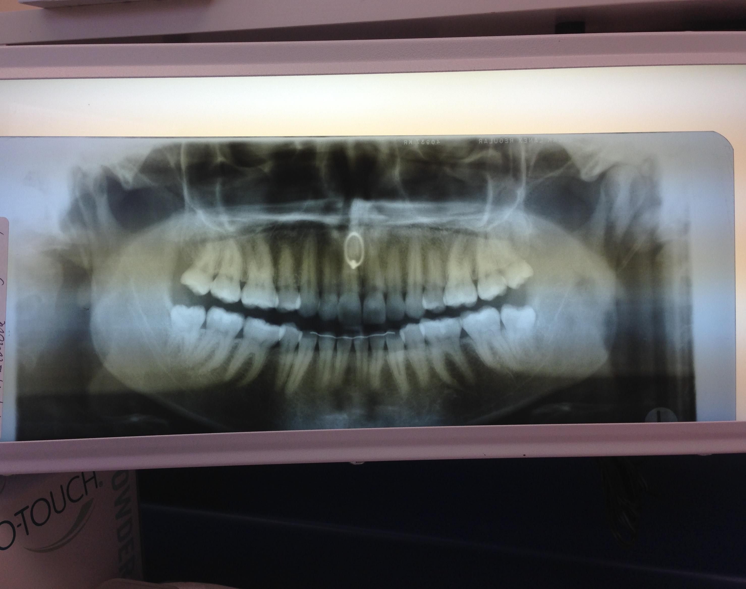 You can see my nose ring in my dental xray r/mildlyinteresting