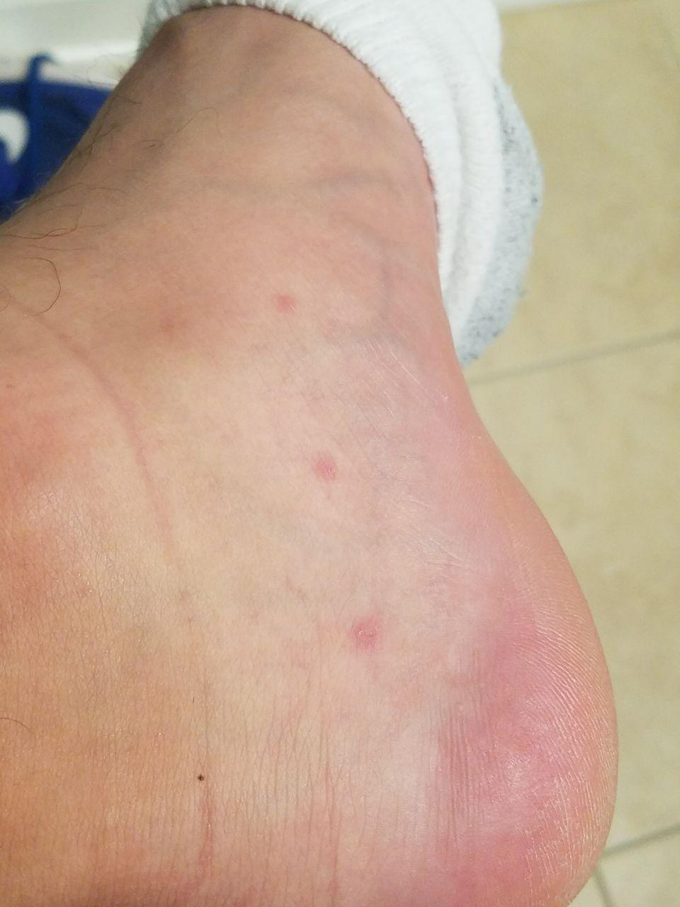 These three mosquito bites on my foot form a perfect line r