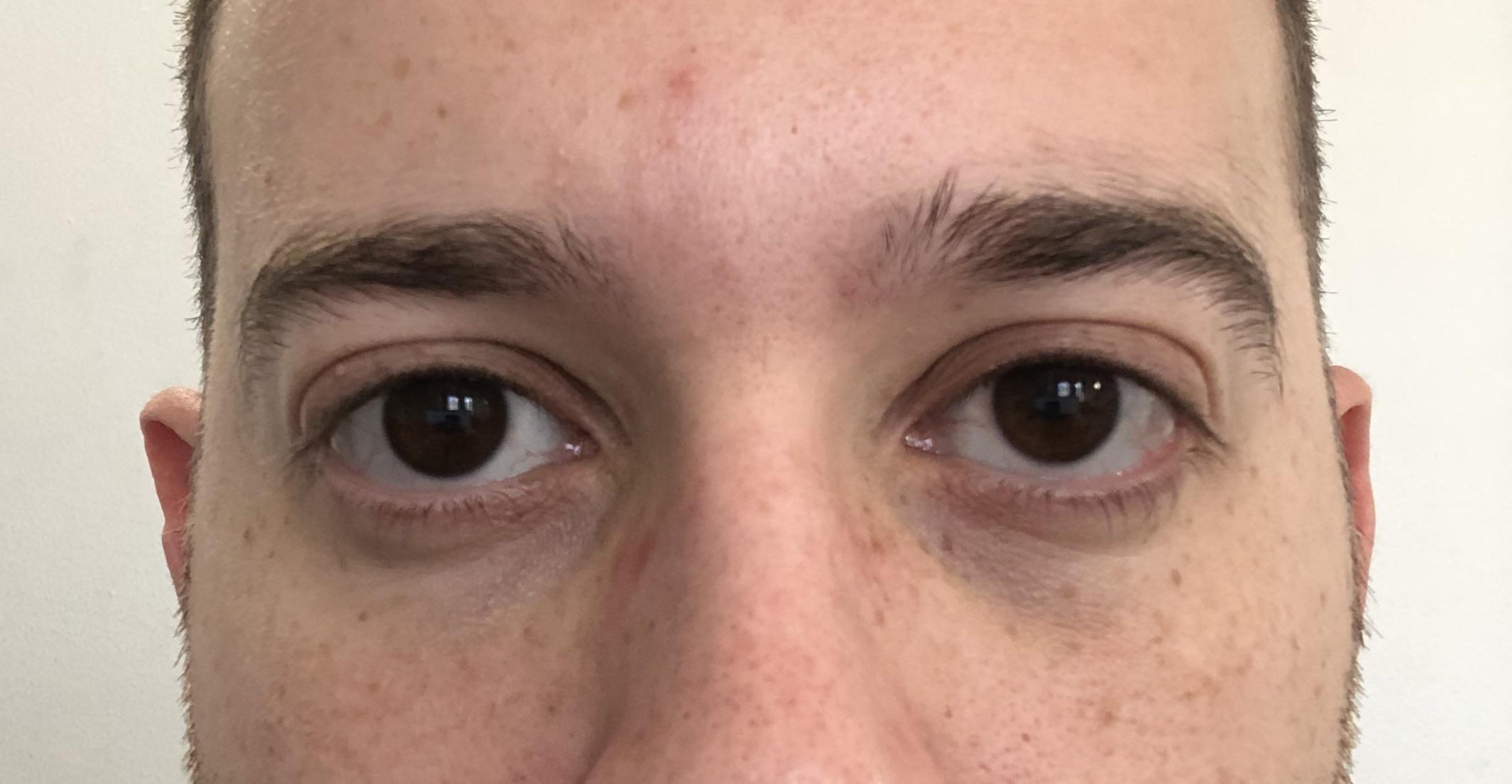 Best procedure for my eyes to get almond shape or catlike eyes? I hate