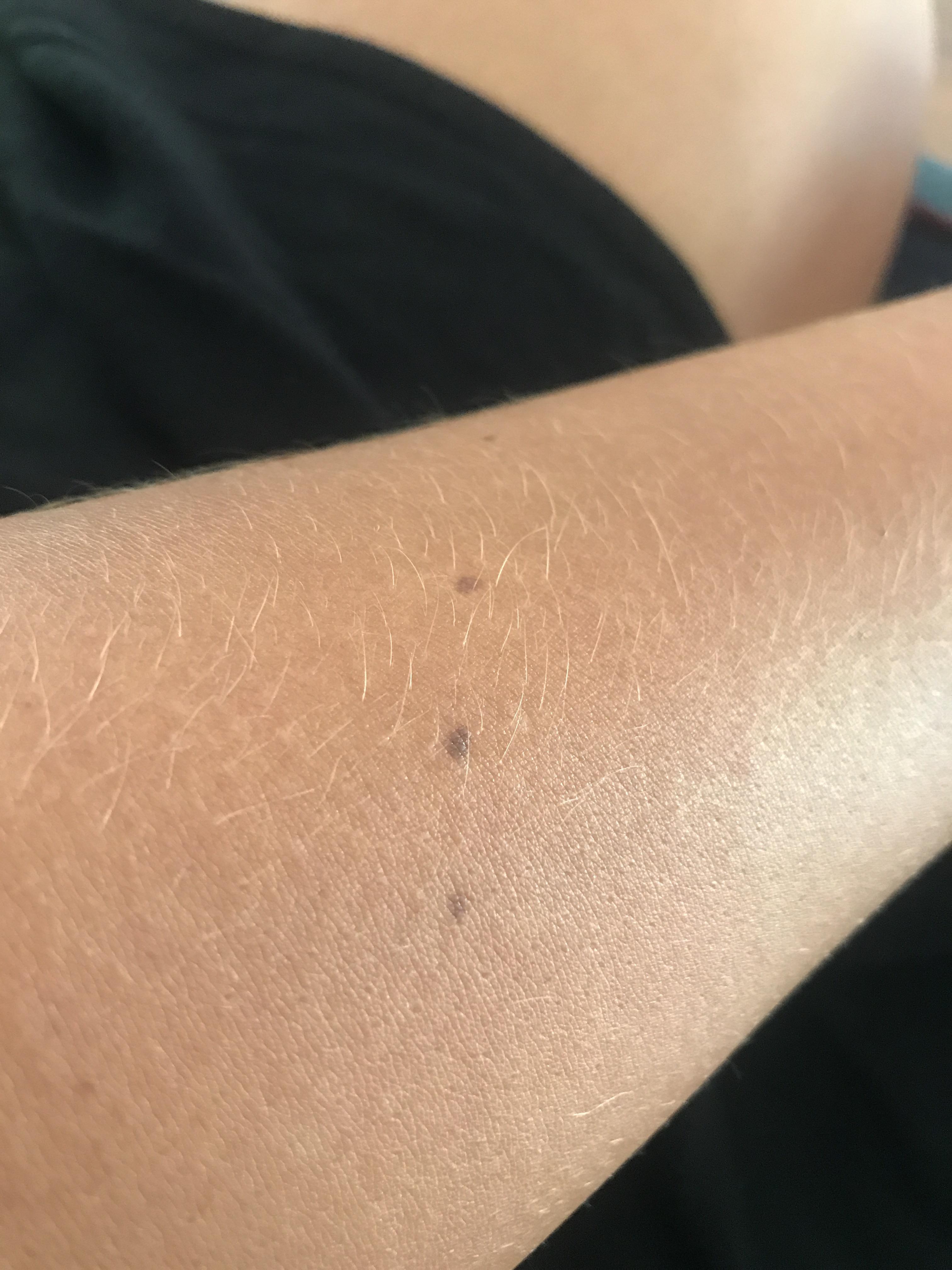 Orion’s Belt on my arm...for years I’ve felt like this has some