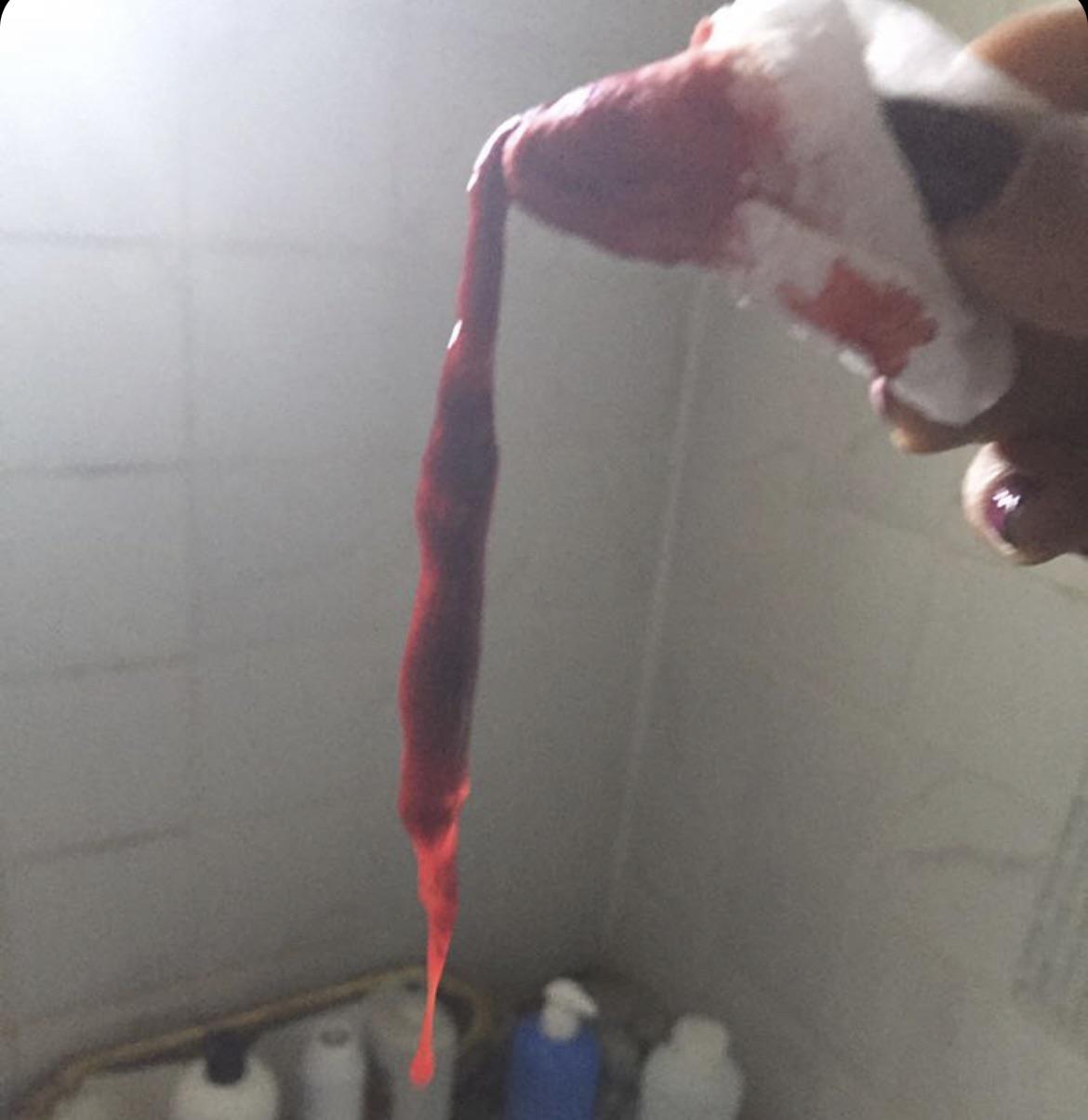 1 best u/pale_context3100 images on Pholder blood clot from nosebleed