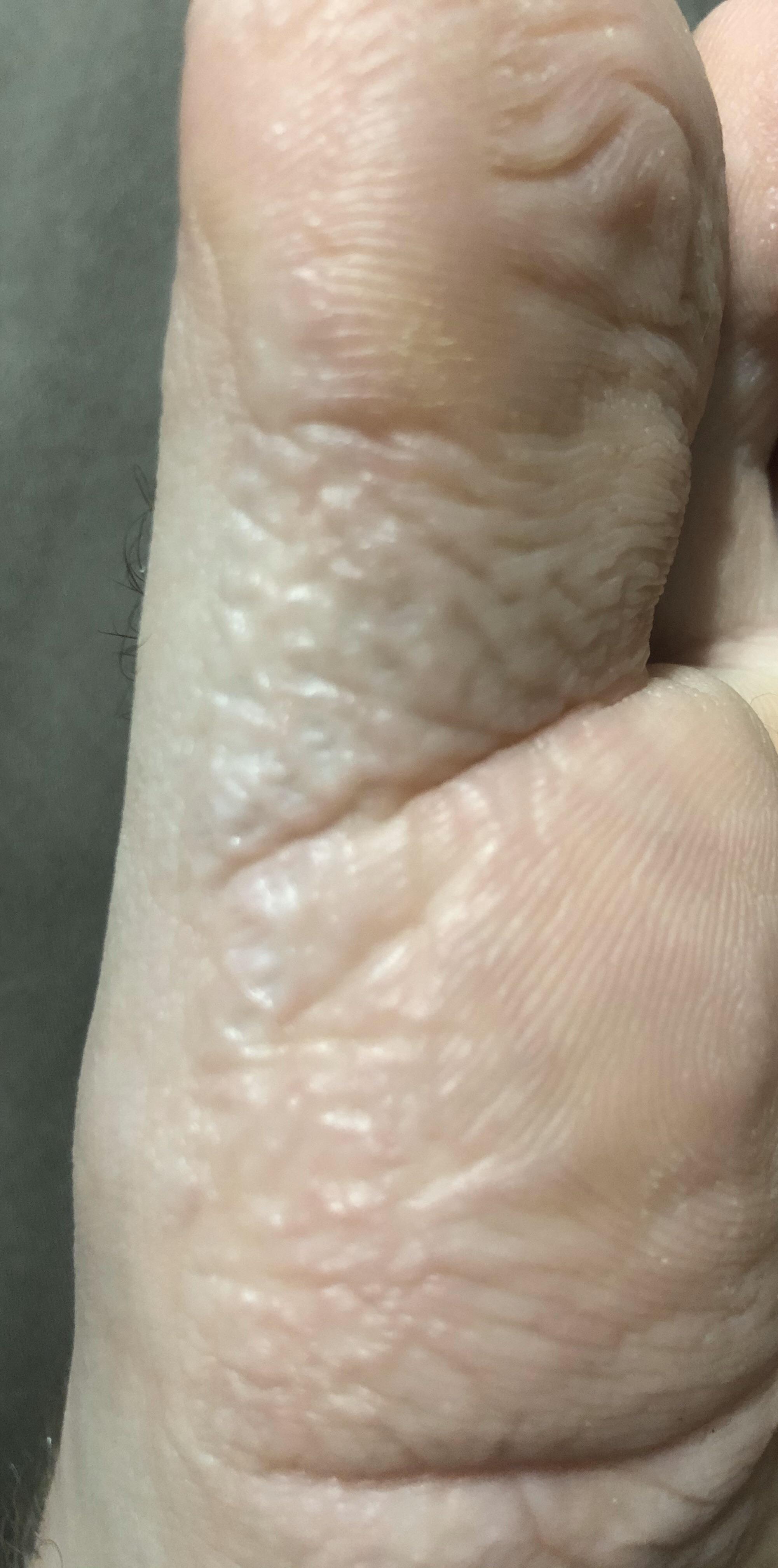 Paint thinner burn? Need doctor? Info in comments. r/medical