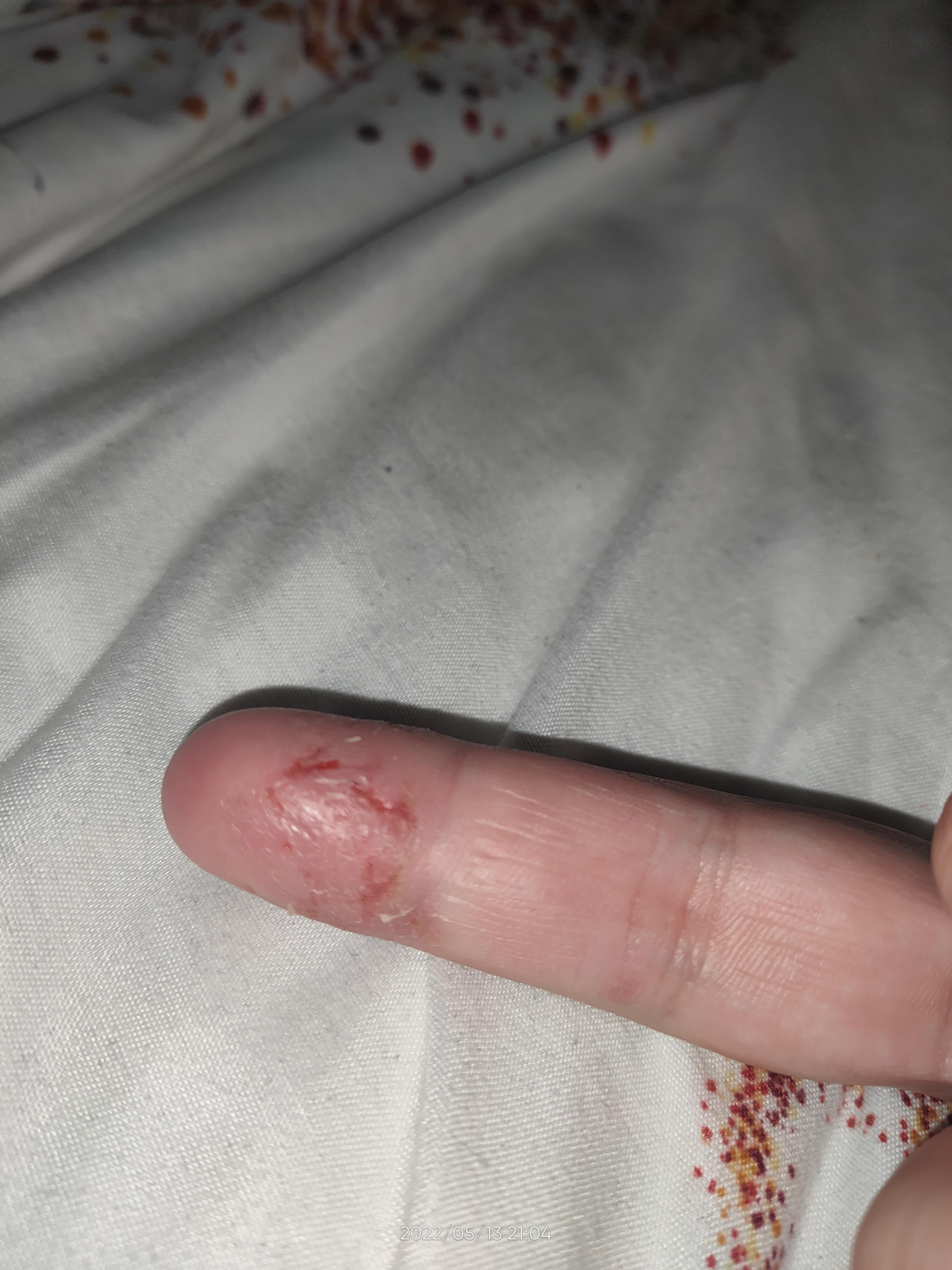 Any tips on how to heal this dry cracked finger SkincareAddicts