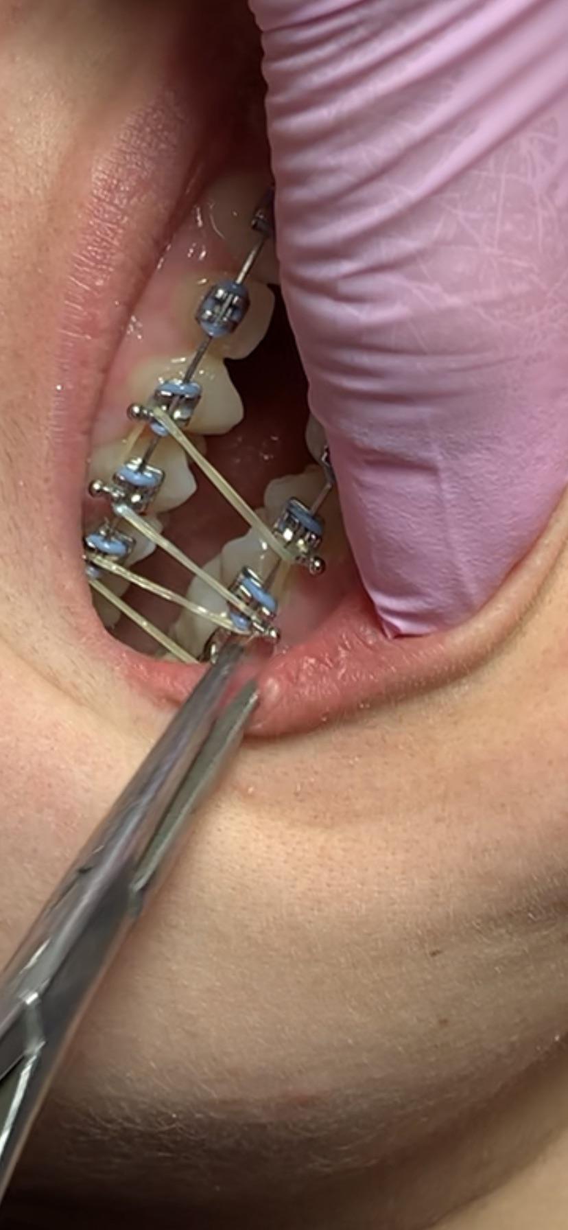 Does this rubber band placement look normal? It’s a rectangle followed