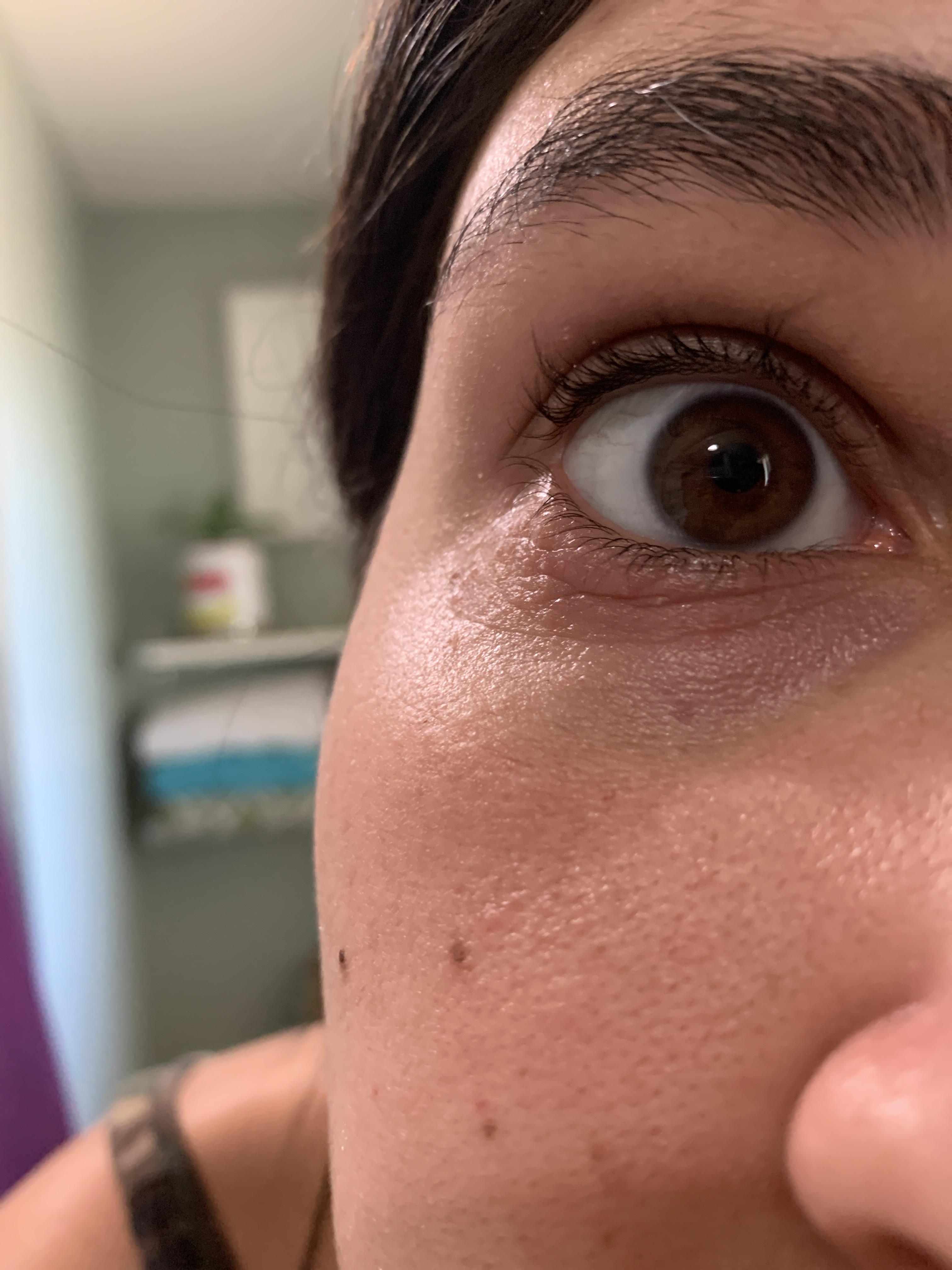 Is this eczema? I struggle really bad with it around my knees elbows