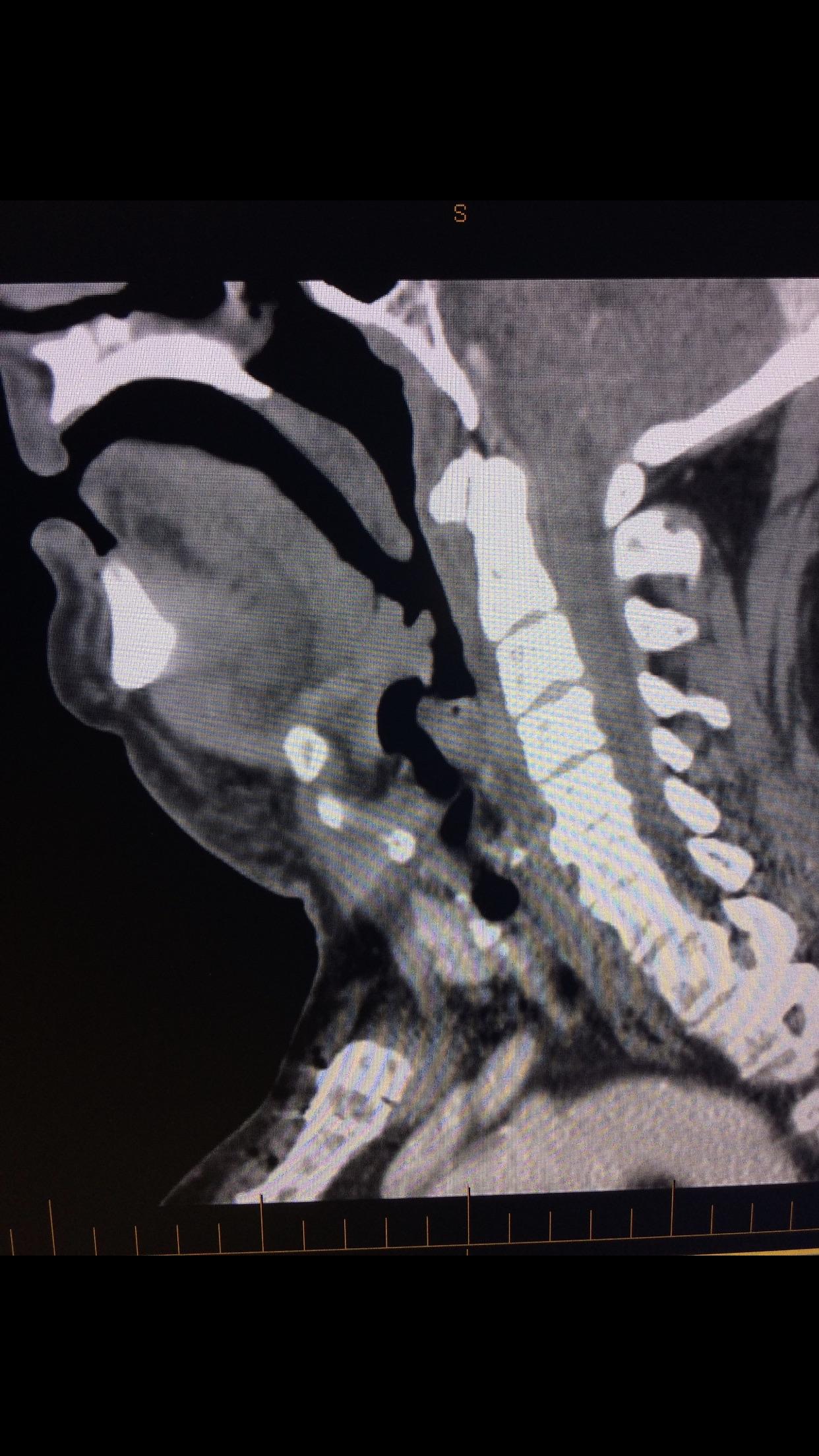 72M presents to the Emergency Department with shortness of breath... Hx