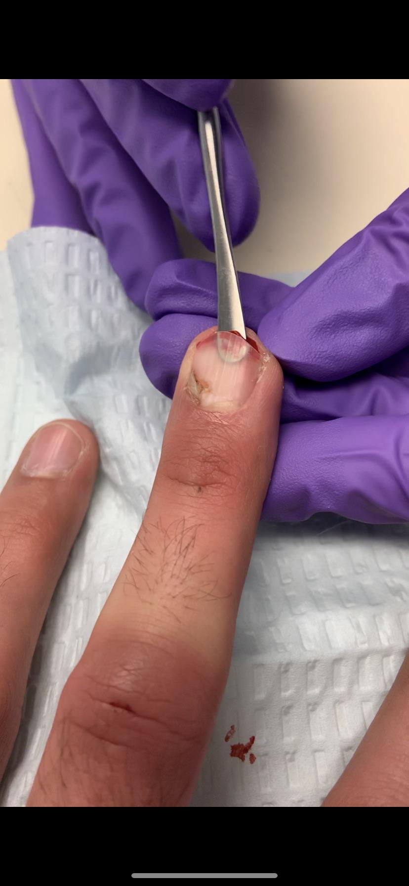 How Can I Remove The Overlay From My Nail Should You Get A Silk Wrap