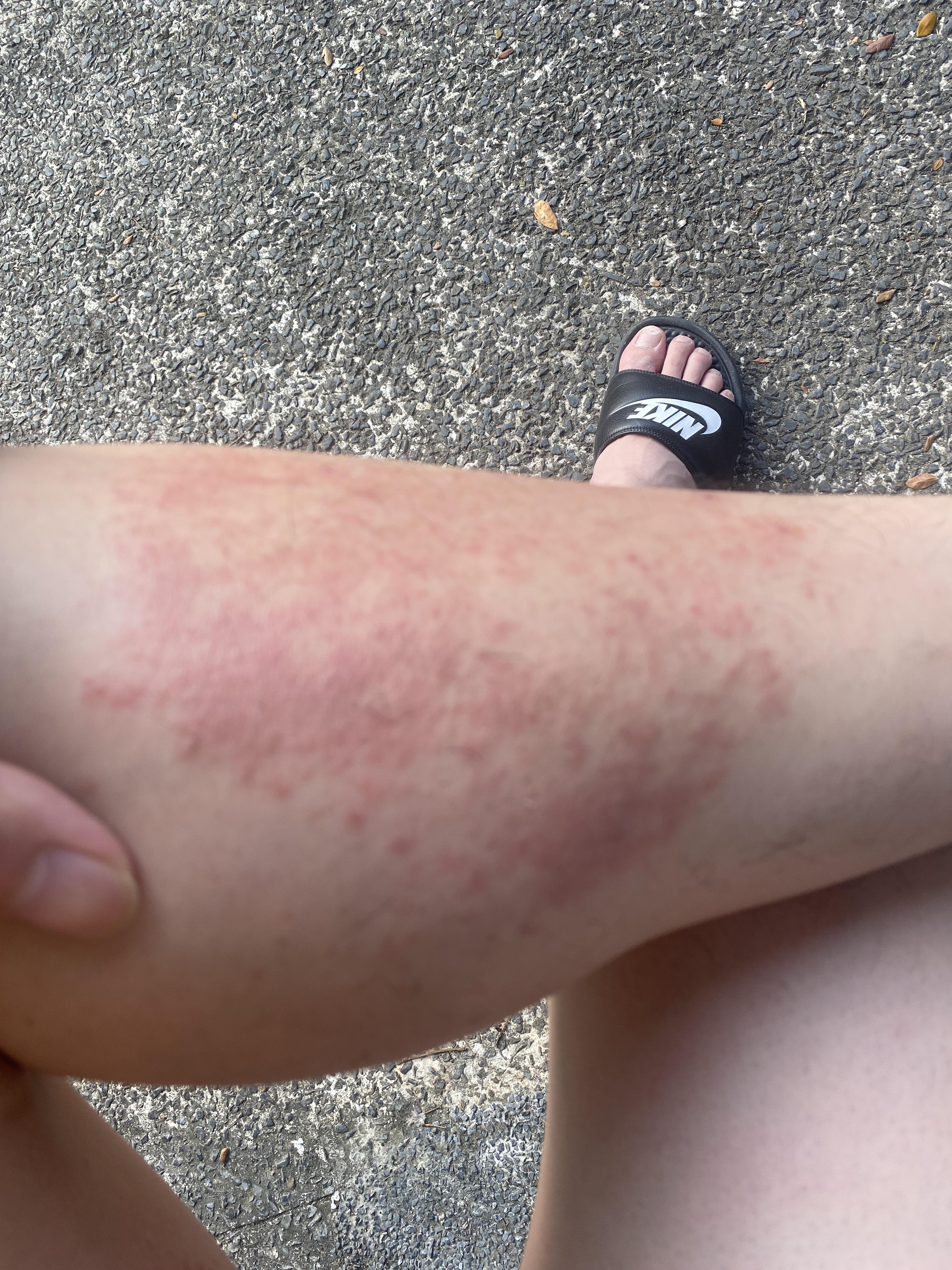 Isotretinoin caused eczema. Anyone else have had a similar experience