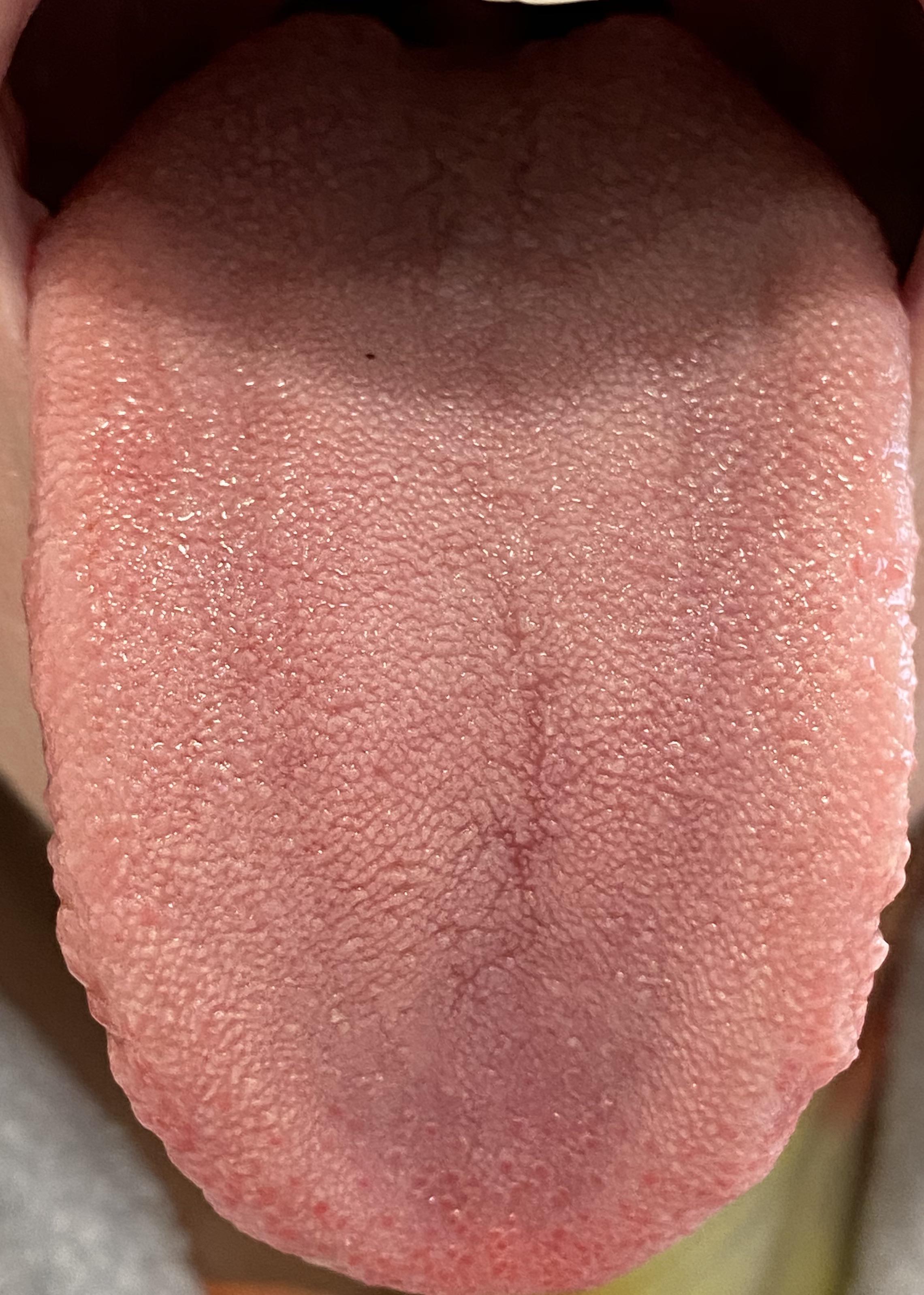 Does this look like thrush or a normal tongue? r/Candida