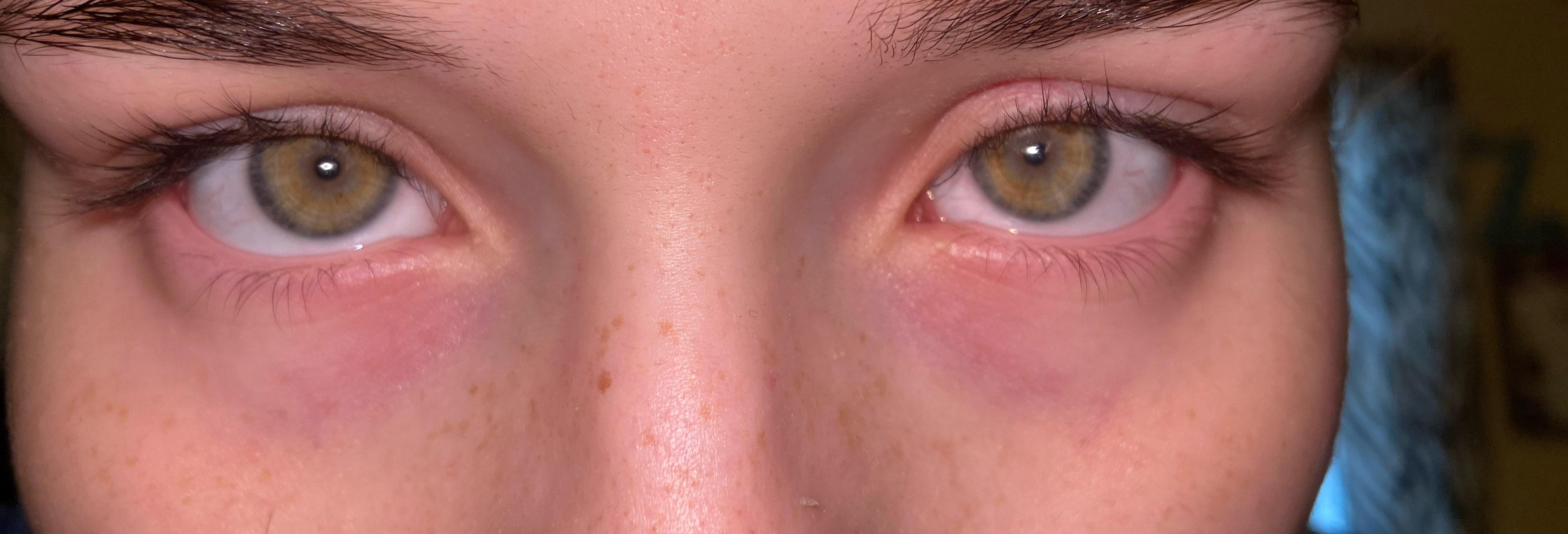 I have really dark eye bags and very thin I’m assuming saying I can see