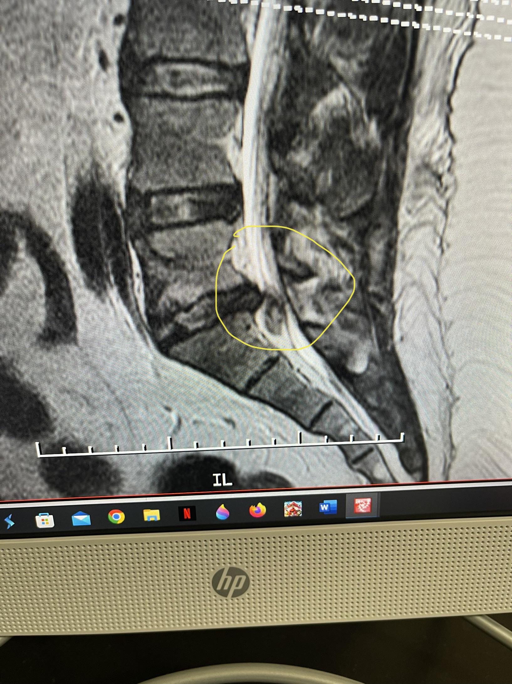 Herniated disc, surgery next week, “minimally invasive microdiscectomy