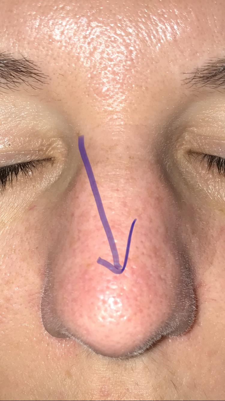 Any advice for this skin colored bump on my nose? I feel like it’s