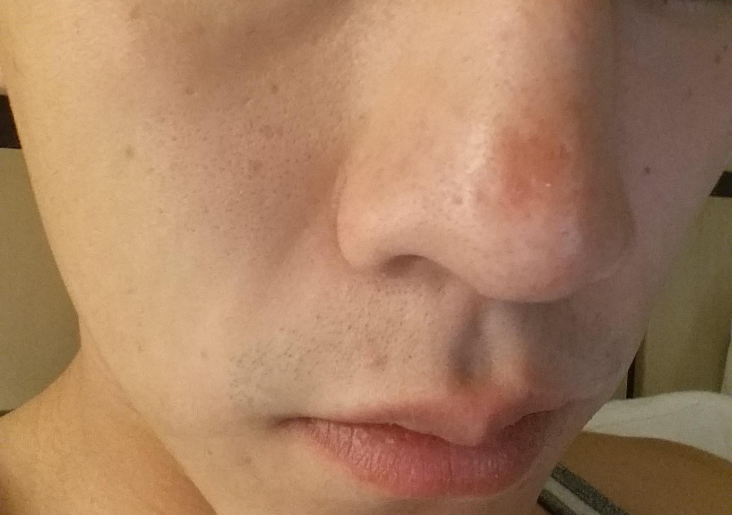 [Skin Concern] I've had this dark spot on my nose for around 3 weeks