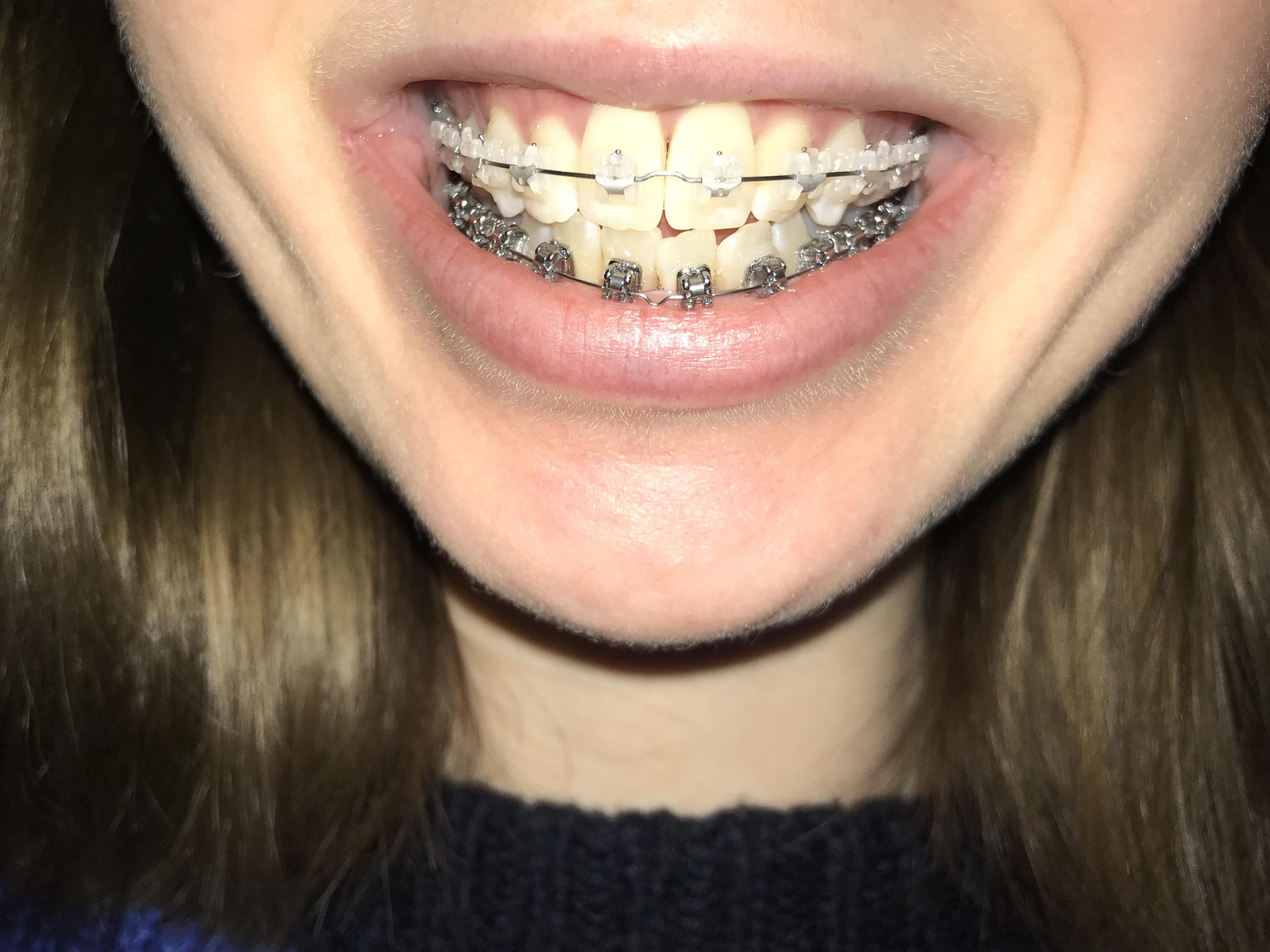 does anyone know what that bend in the wire between the front teeth is