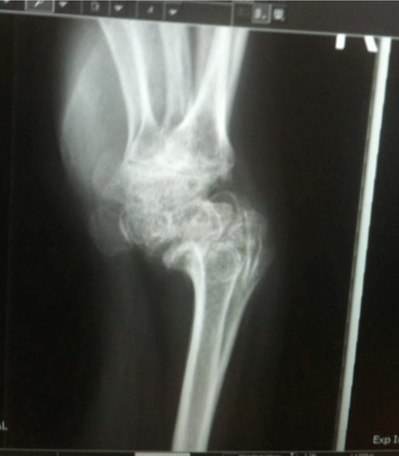 Psoriatic arthritis ate my wrist joints & 3 carpal bones (Part 2