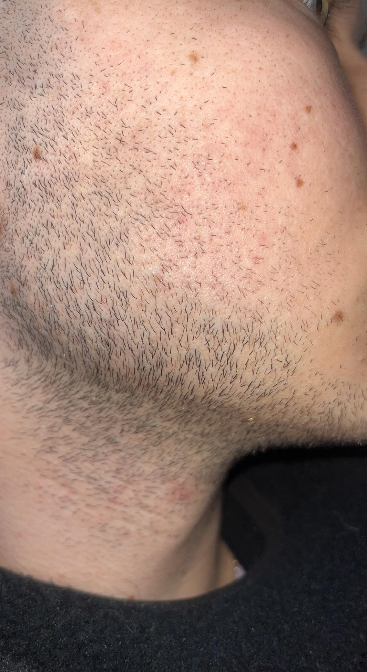 Am I seeing vellus hairs here? r/Minoxbeards