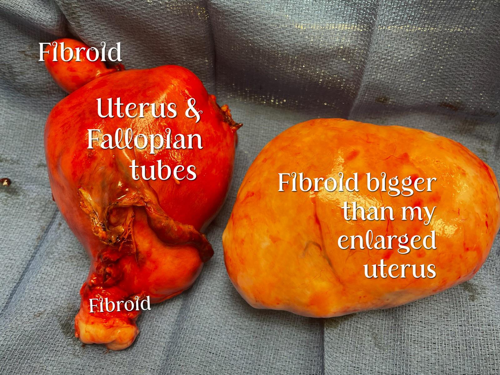 1 Day Post Op Total Hysterectomy. r/Fibroids