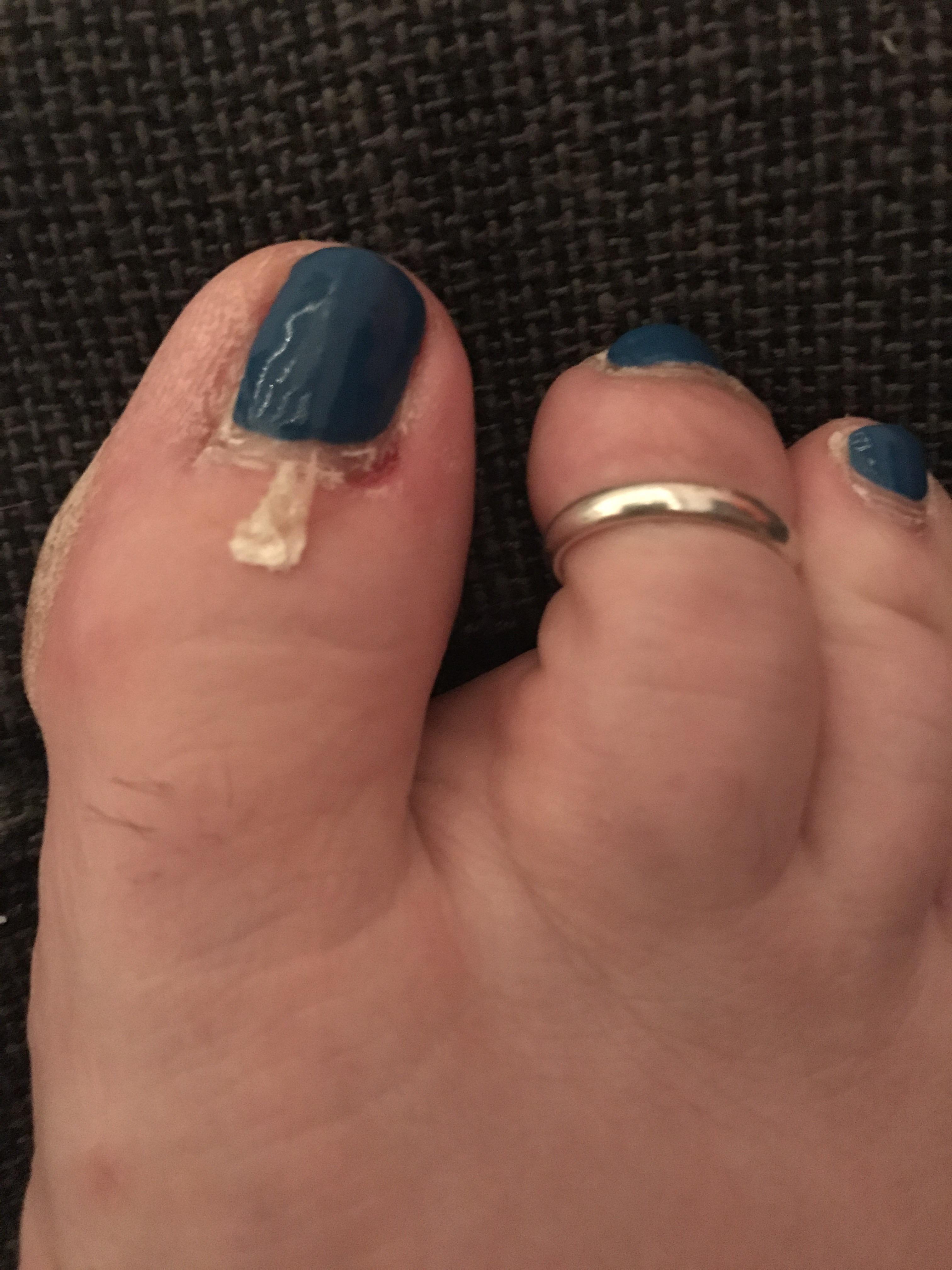 Excuse the grownout manicure. Pulled the beginnings of an ingrown nail