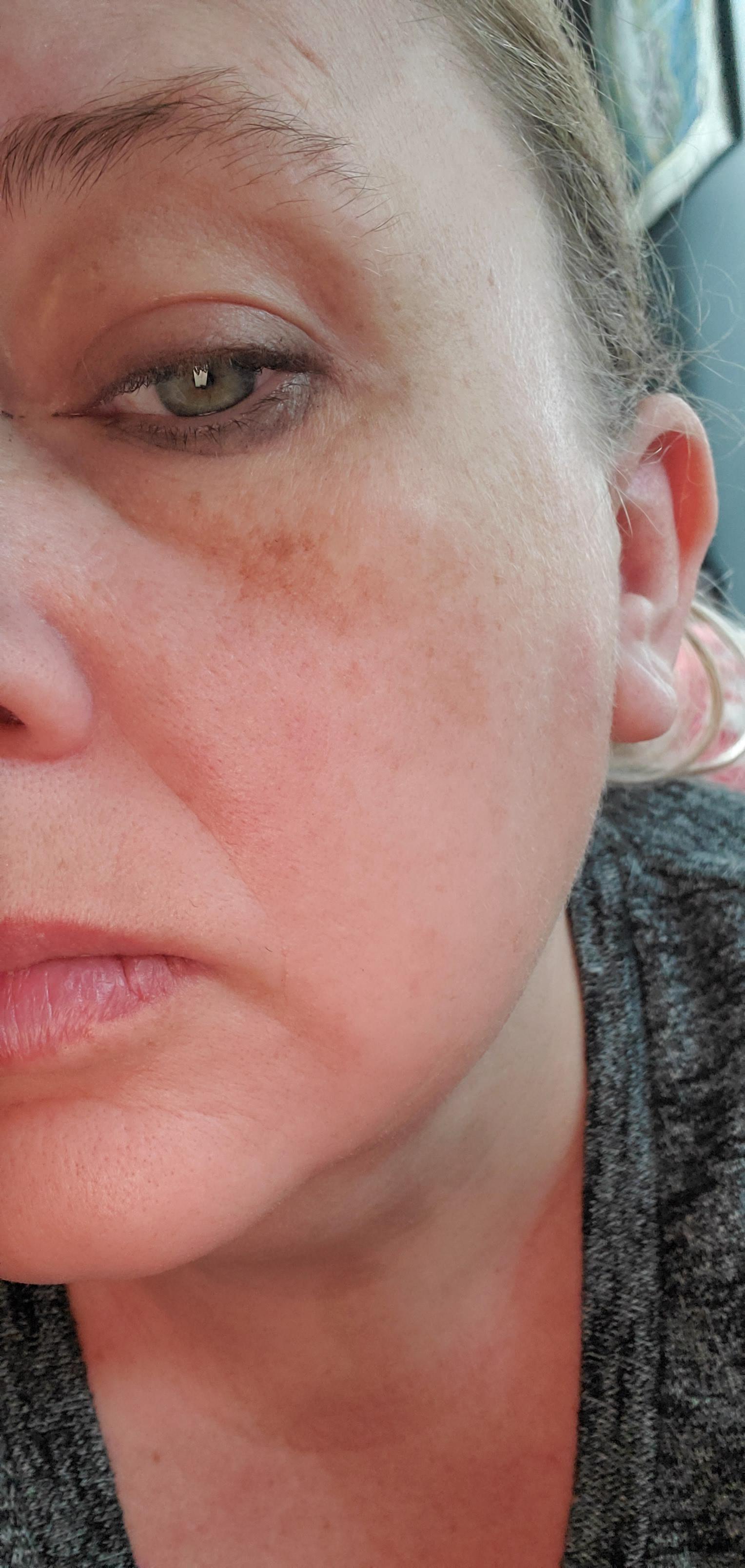 Please help. My skin is all different textures now. Huge bags under my