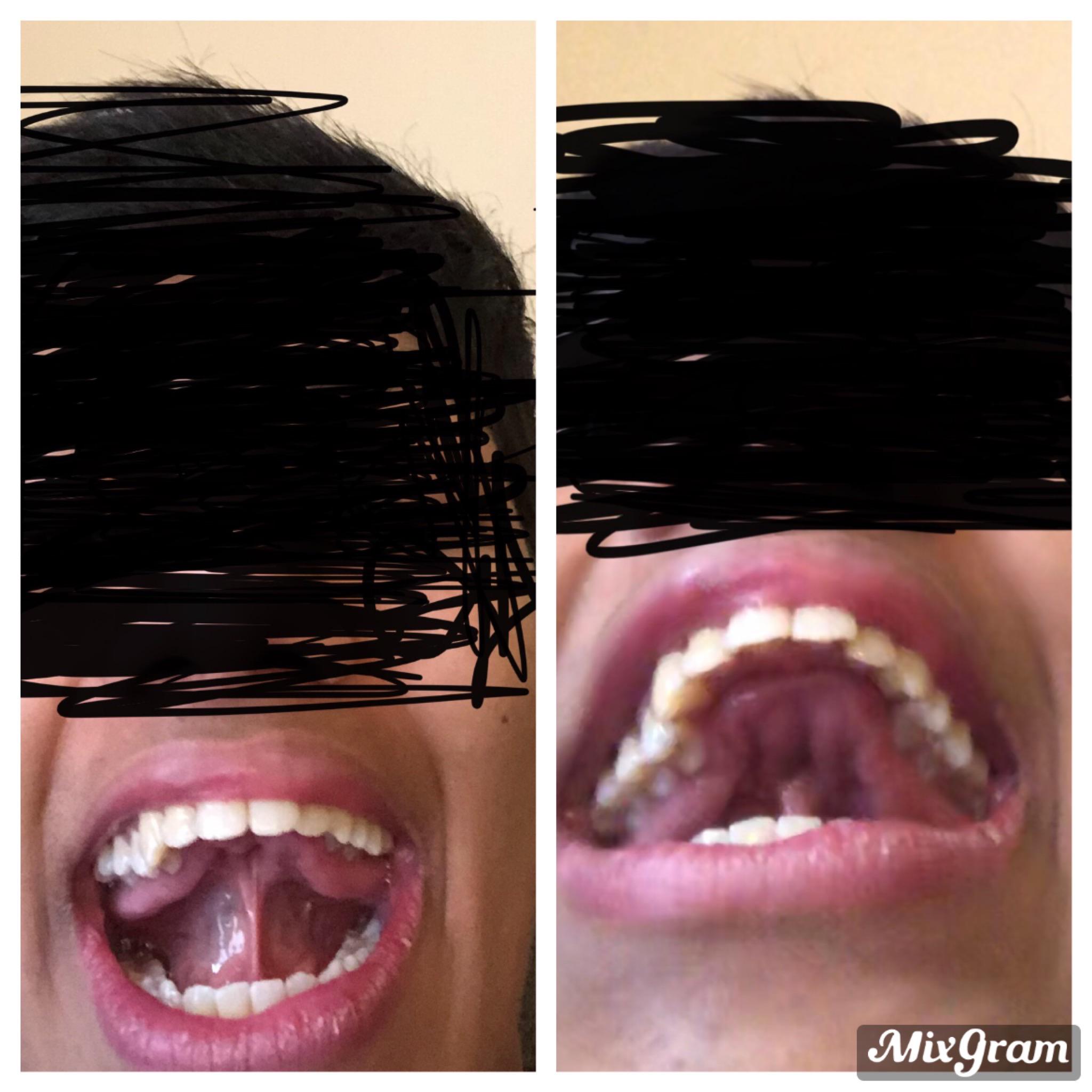 Can we settle whether or not it is safe to mew with the tongue touching