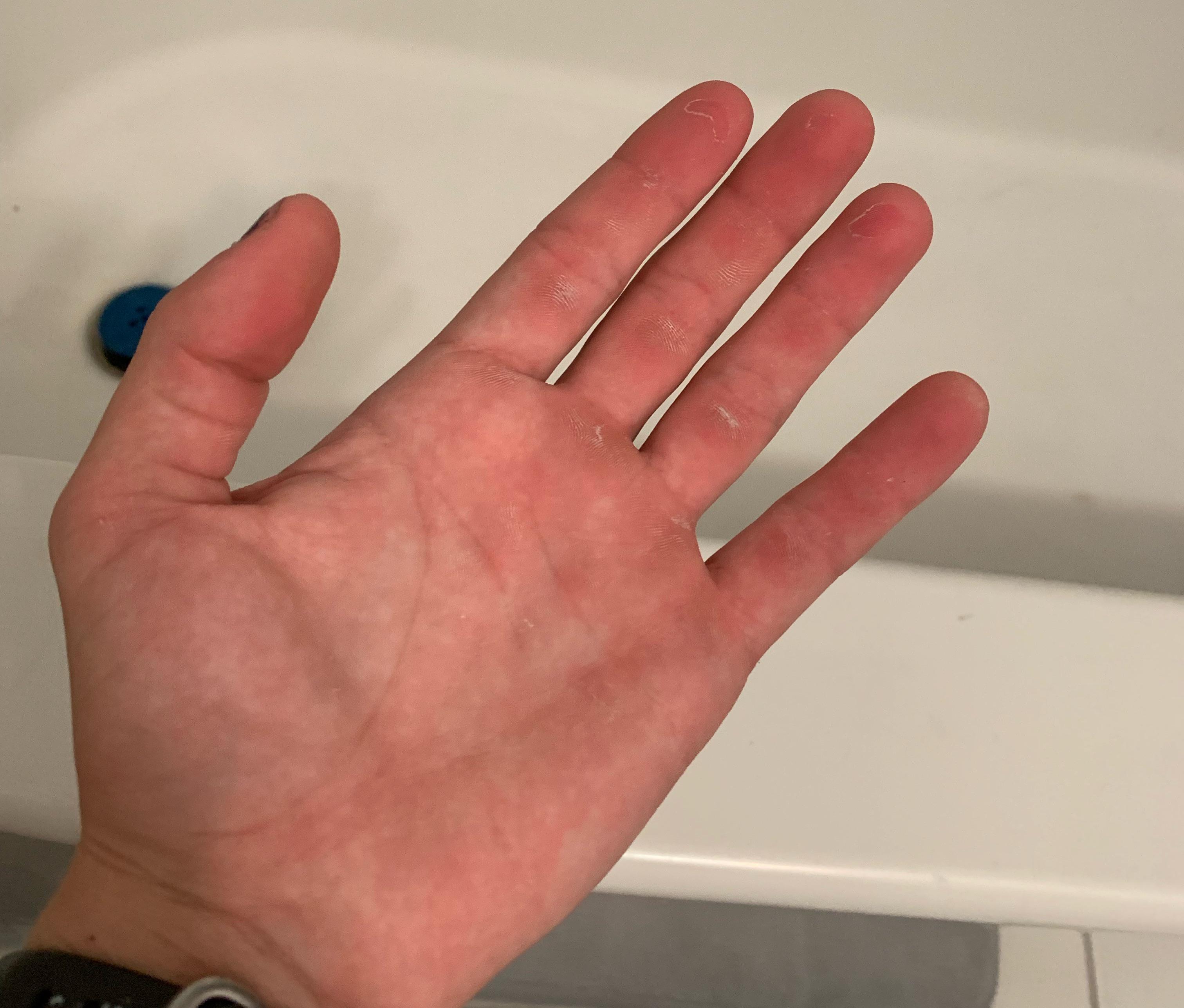 It’s been a while since I’ve had my calluses rip and it feels good r