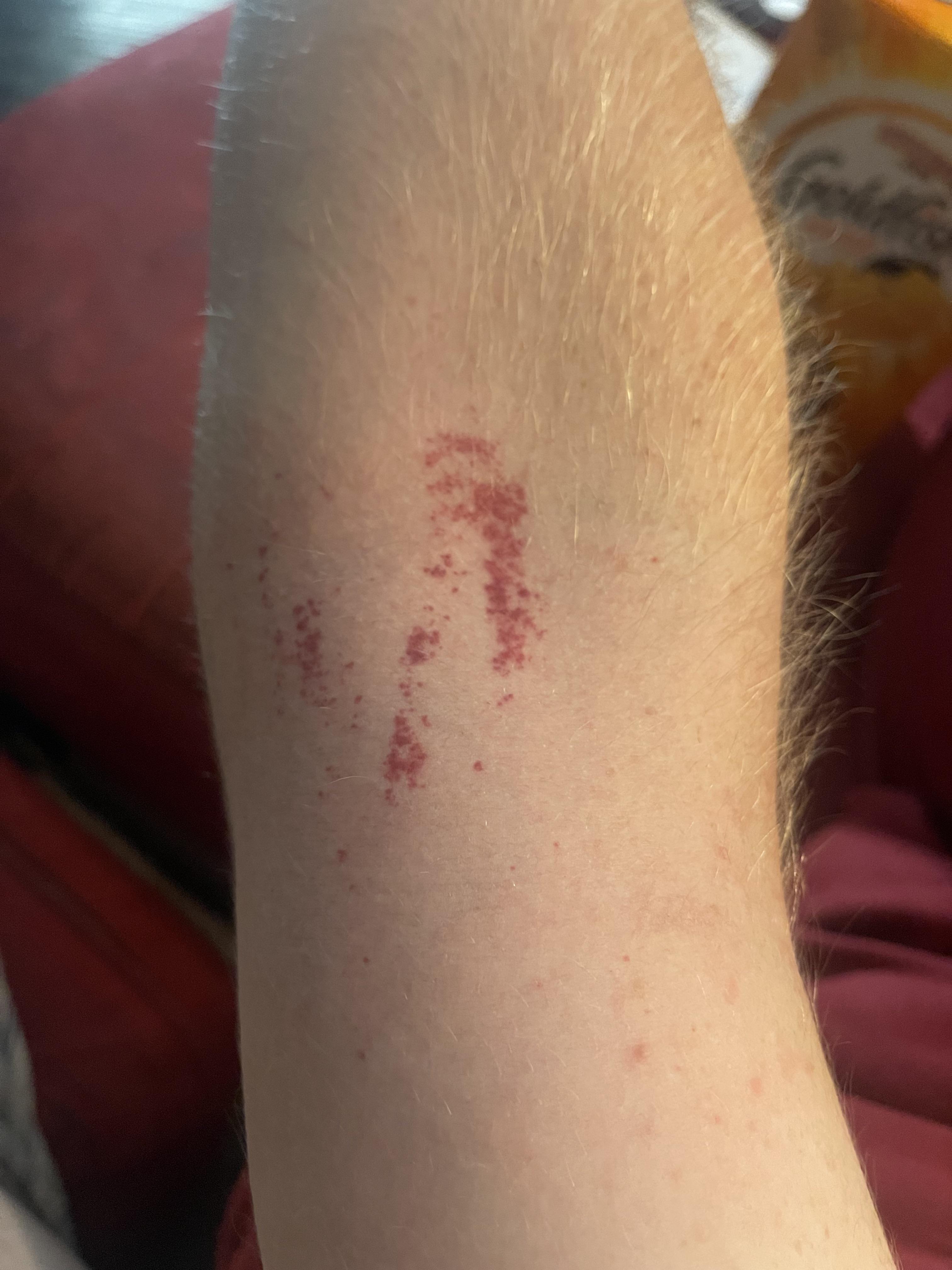 Skin redness r/medical