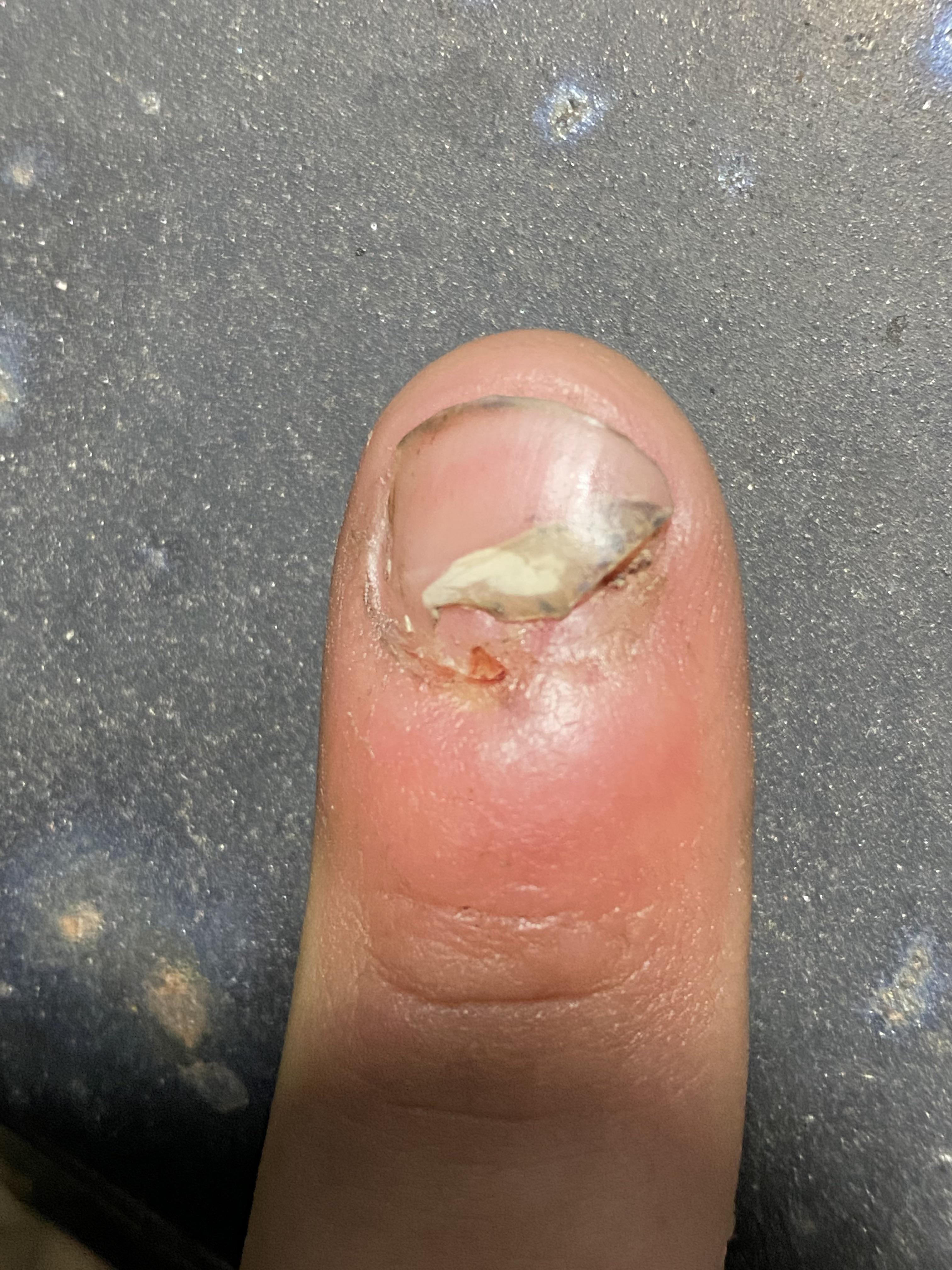 Best way to help nail bed injury heal? r/medical