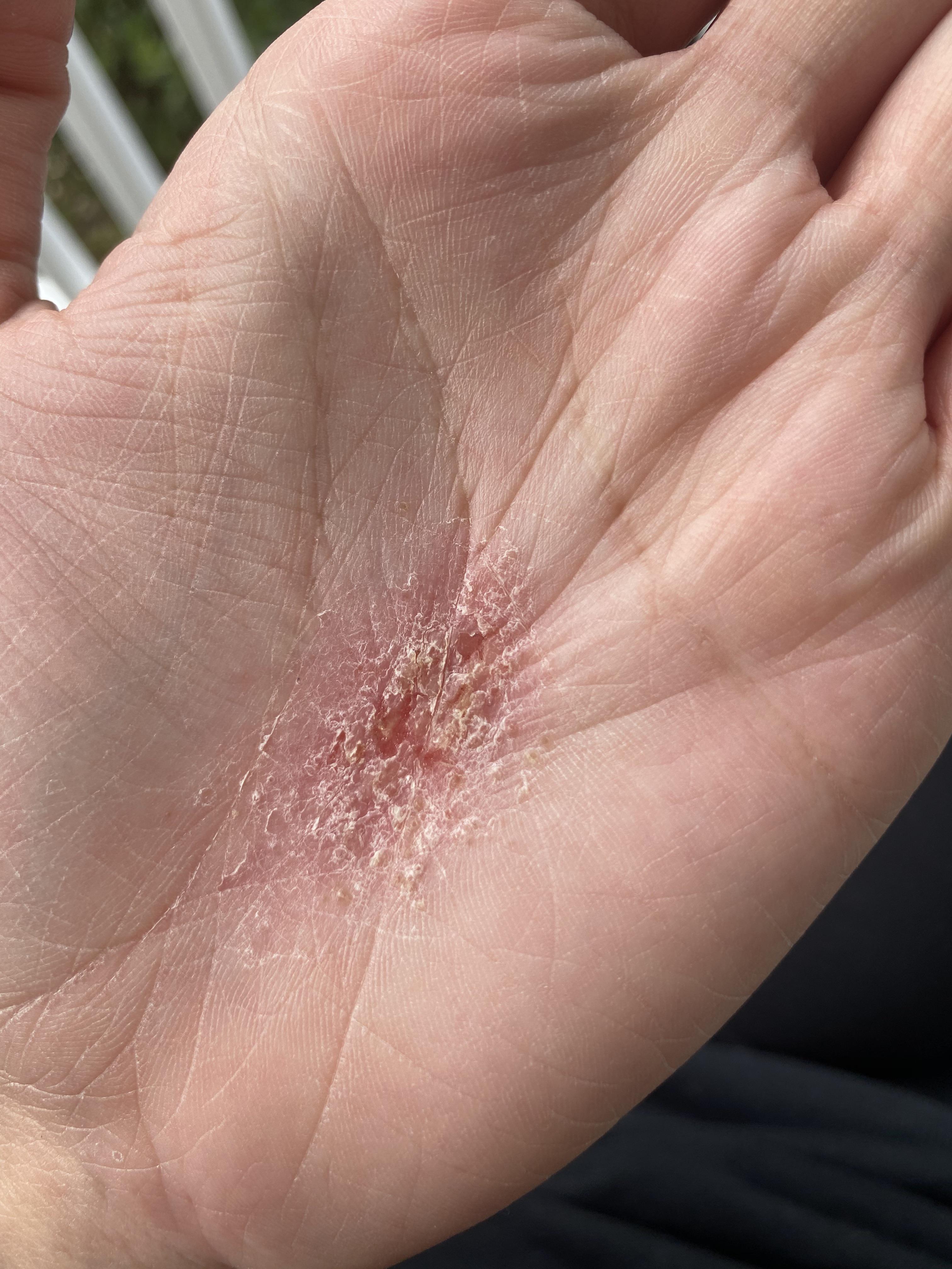 Rash on hand with tiny fluid filled blisters under skin won’t go away