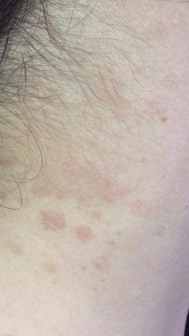 Skin slightly flakey and discolored on neck. Does anyone know what this