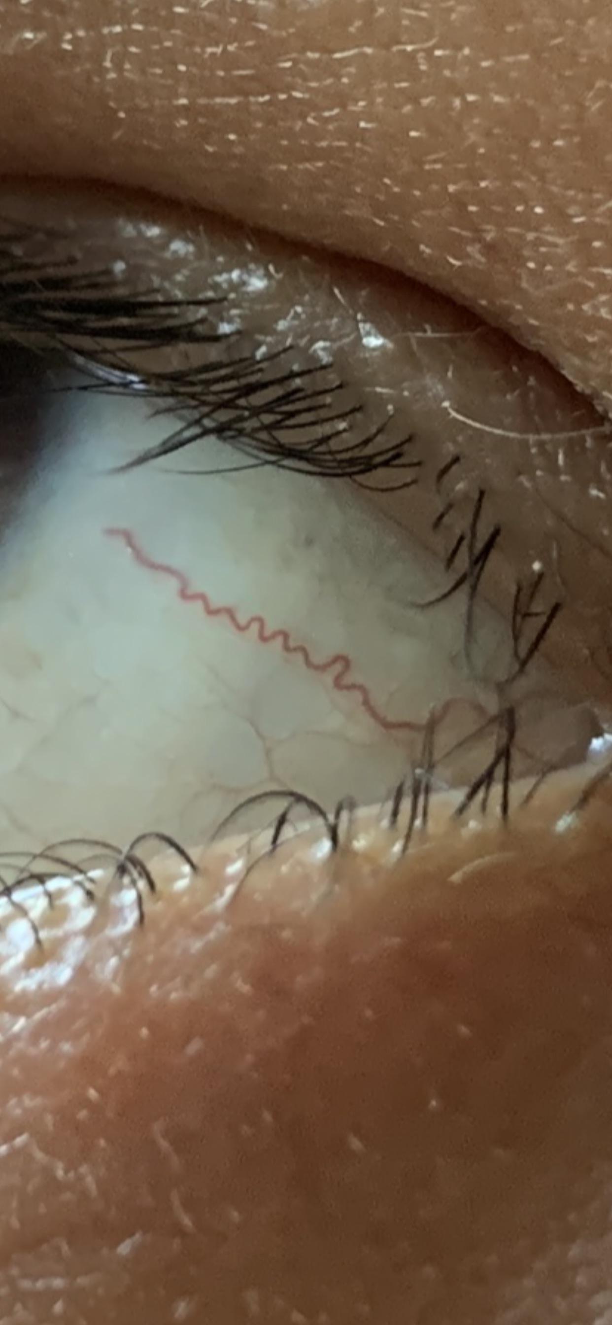 Wiggly vein on eyeball r/mildlyinteresting