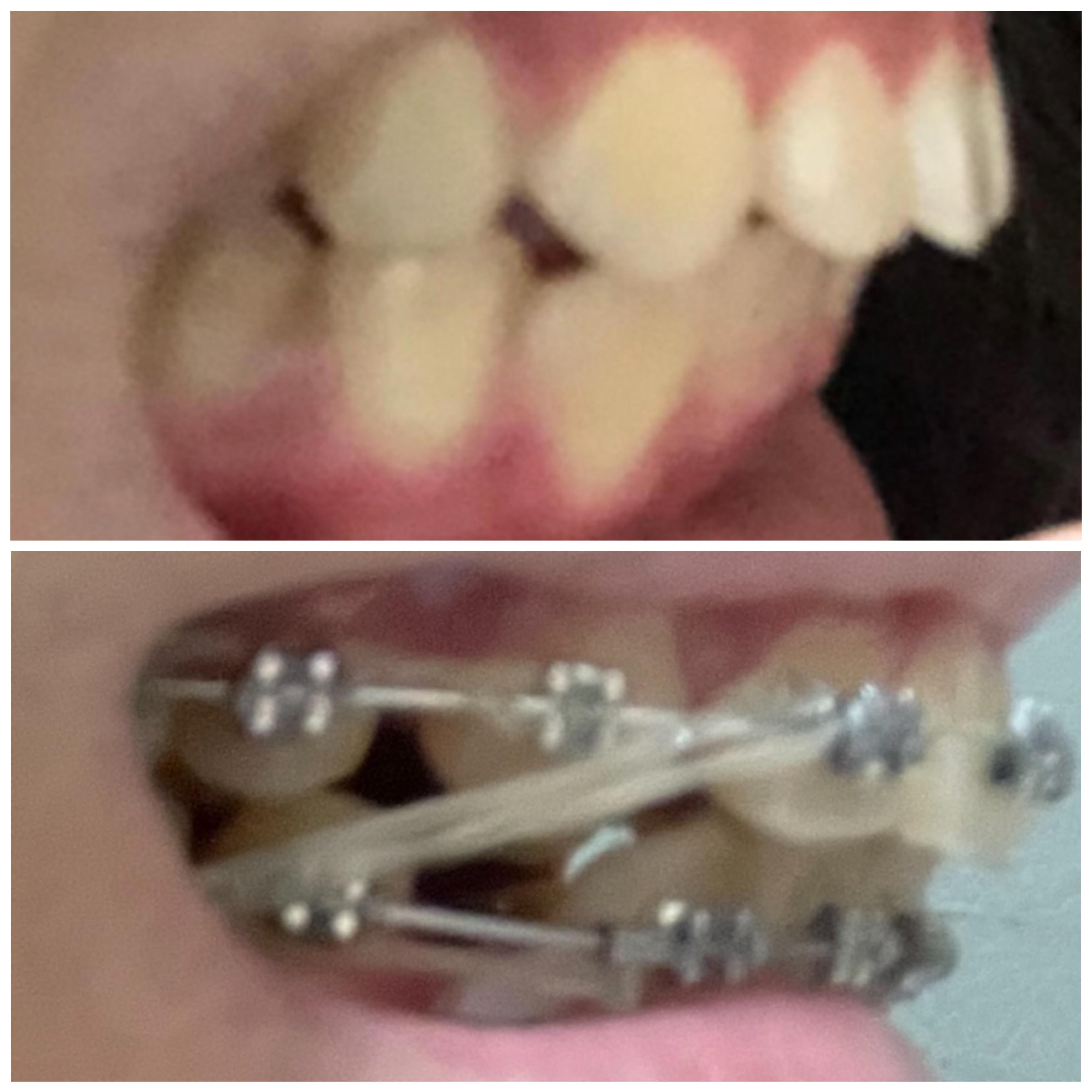 Another bimaxillary protrusion progress pic! (At 6months rn) r/braces
