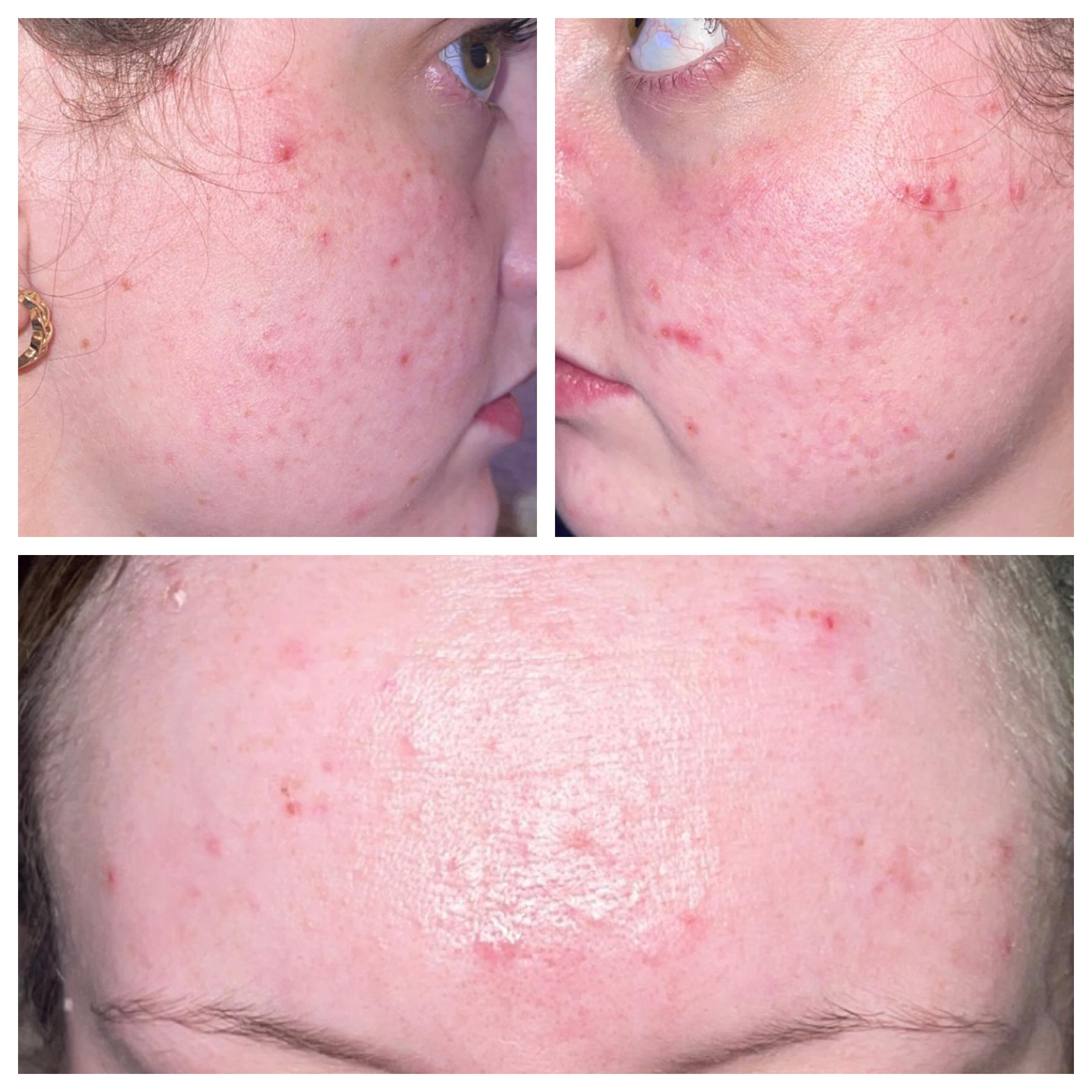 Skin Cycling..PURGE? Or irritation? 1 week into starting tretinoin