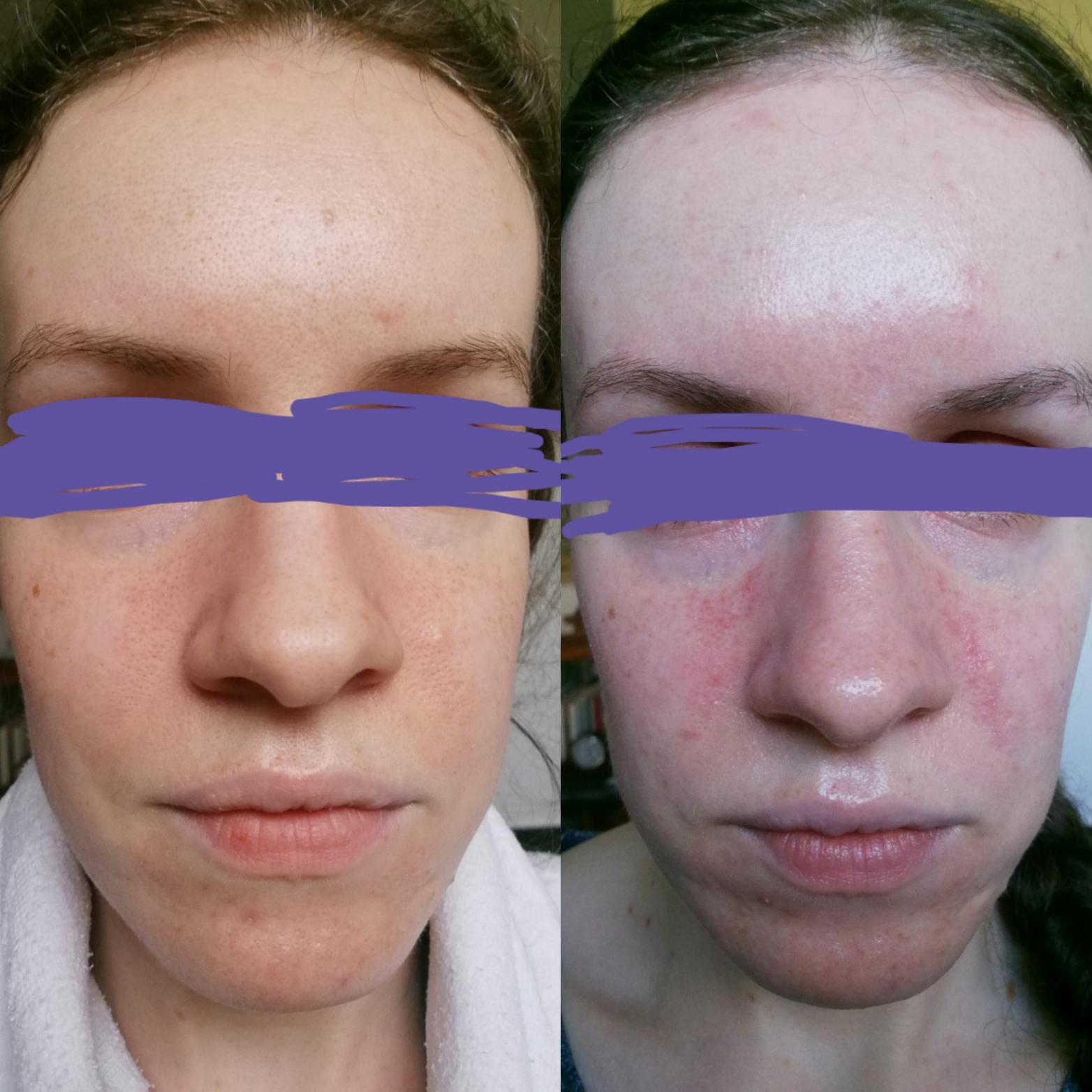 [B&A] Huge thanks to this sub and my GP for making me realise I have