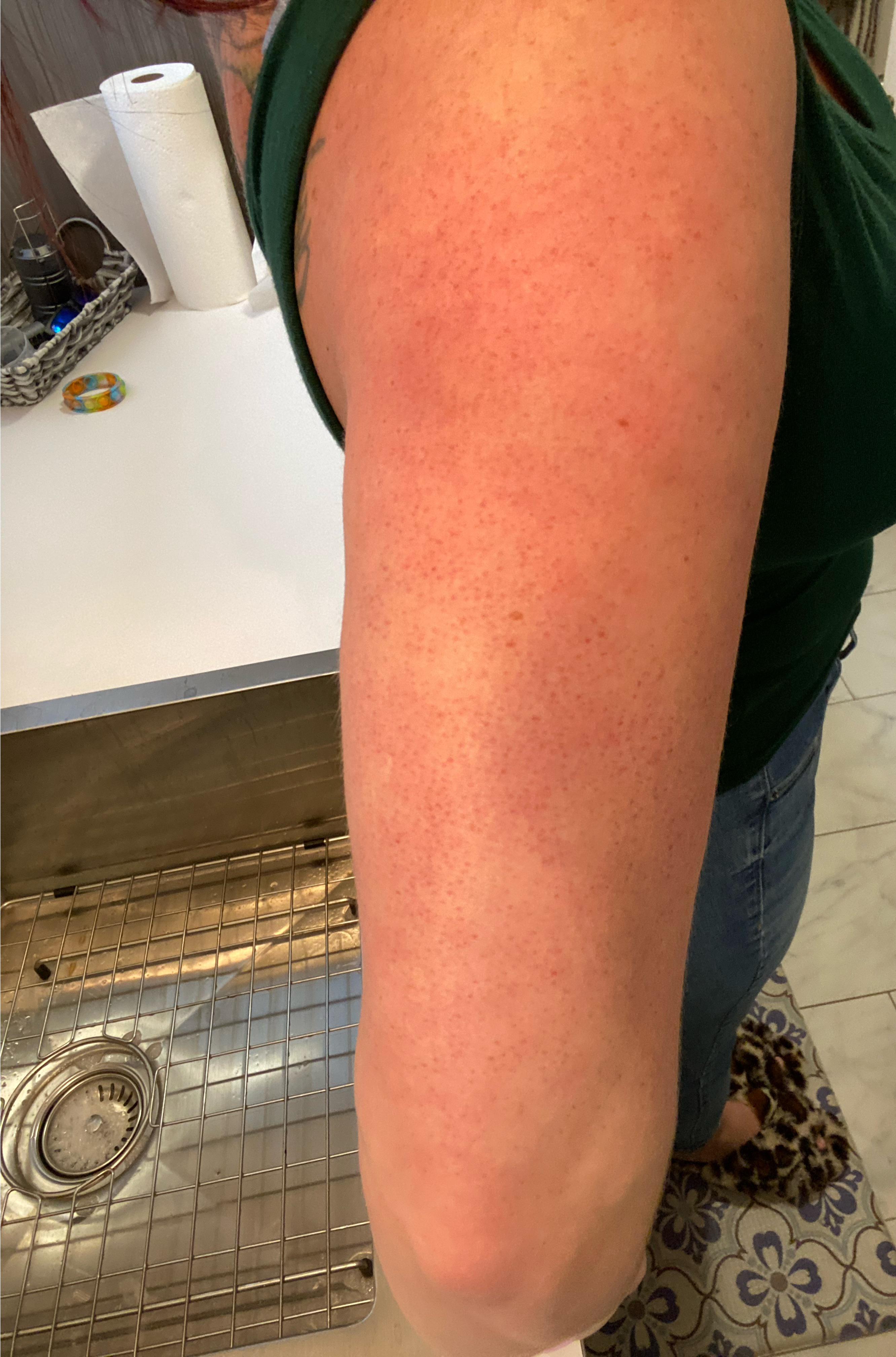 Redness On Upper Arms