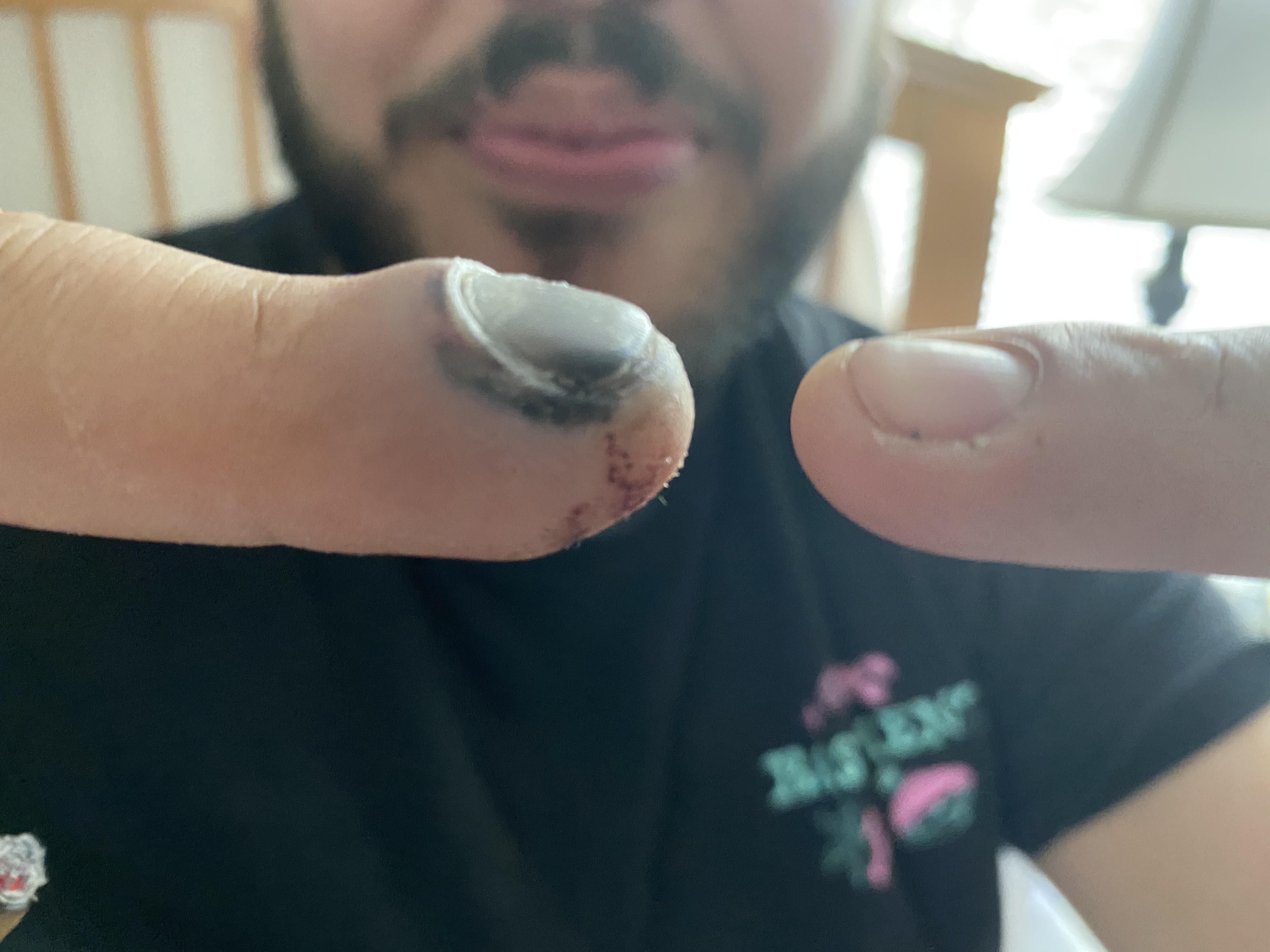 Slammed finger in a car door. Doctor or no? medical_advice
